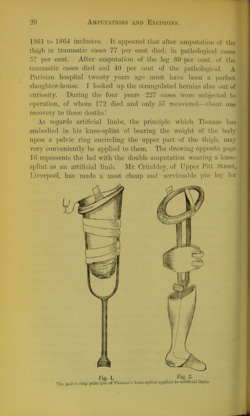 1861 to 1864 inclusive. It ap))eare(l that after auiinitatioii of tlie thigh in traumatic cases 77 per cent died; in path(jlogicid ca.se.s 57 per cent. After amputation of tlie leg 80 per cent, (jf the traumatic cases died and 40 per cent of the ])athoIogi( id. A Parisian hospital twenty years ago must ha\e been a perfect slaiighter-liouse. I hjoked up the strangulated hernias also out of curiosity. During the four years 227 cases were subjected to operation, of whom 172 died and only 55 recovered—about one recovery to tliree deatlis 1 As regards artificial limbs, the principle wliicli Thomas li;i> embodied in his knee-splint of bearing the weight of the l)0(ly upon a pelvic ring encircling the upper part of the thigh, nuiy very conveniently be applied to them. The drawing opposite page 10 represents the lad with the double amputation wearing a ]<\mt- Rplint as an artificial limb. Mr. Critchley, of Upper Pitt Street, Liverpool, has made a most cheap and ser\'iceable ])iii leg for