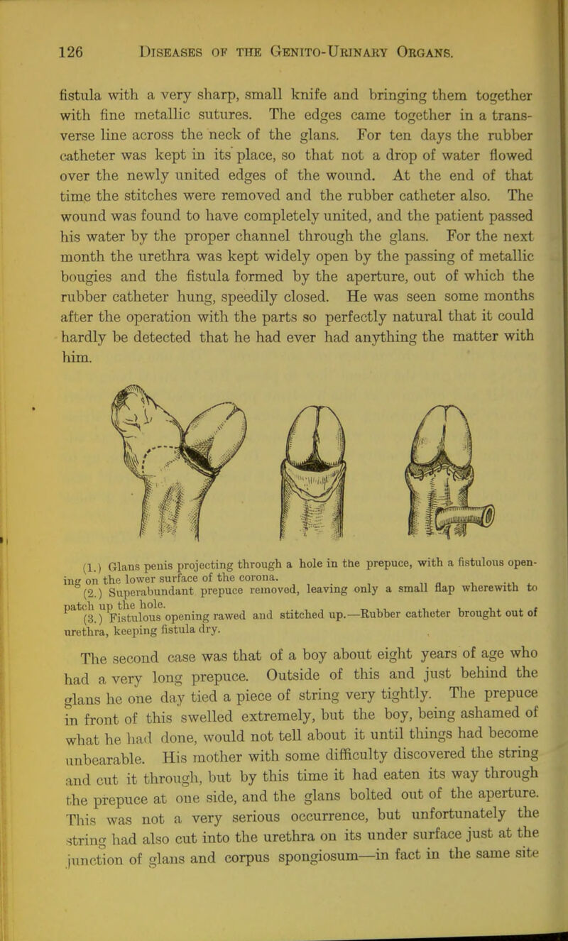 fistula with a very sharp, small knife and bringing them together with fine metallic sutures. The edges came together in a trans- verse line across the neck of the glans. For ten days the rubber catheter was kept in its place, so that not a drop of water flowed over the newly united edges of the wound. At the end of that time the stitches were removed and the rubber catheter also. The wound was found to have completely united, and the patient passed his water by the proper channel through the glans. For the next month the urethra was kept widely open by the passing of metallic bougies and the fistula formed by the aperture, out of which the rubber catheter hung, speedily closed. He was seen some months after the operation with the parts so perfectly natural that it could hardly be detected that he had ever had anything the matter with him. The second case was that of a boy about eight years of age who had a very long prepuce. Outside of this and just behind the glans he one day tied a piece of string very tightly. The prepuce in front of this swelled extremely, but the boy, being ashamed of what he had done, would not tell about it until things had become unbearable. His mother with some difficulty discovered the string and cut it through, but by this time it had eaten its way through the prepuce at one side, and the glans bolted out of the aperture. This was not a very serious occurrence, but unfortunately the string had also cut into the urethra on its under surface just at the juncSon of glans and corpus spongiosum—in fact in the same site urethra, keejiing fistula dry.
