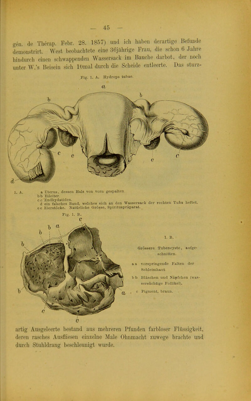 oen. tle Tlievap. Febr. 28. 1857) iiiul ich haben derartige liefunde domoiistrirt. West beobachtete eine 3Gjährige Frau, die schon 6 Jahre hindurcli einen schwappenden Wassersack im Bauche darbot, der nocli unter W.'s Beisein sich lOmal durch die Scheide entleerte. Das stürz- Fig. 1. A. Hydrops tubae. 1. A. a Uterus, dessen Hals von vorn gespalten, bb Eileiter. c c Endhydatiden. , , ,i . d ein falsches Band, welches sieh an den Wassersack der rechten Tubo heftet, ee Eierstöcke. Natürliche Grösse, Spirituspräparat. Fig. 1. B. c 1. B. Grössere Tubencyste, aufge- schnitten. a a vorspringende Falten der Schleimhaut- b b Bläschen und Näpfchen (was- sersüchtige Follikel). c Pigment, braun. ; 0 artig Ausgeleerte bestand aus mehreren Pfunden farbloser Flüssigkeit, deren rasches Ausfliesen einzelne Male Ohnmacht zuwege brachte und durch Stuhldrang beschleunigt wurde.