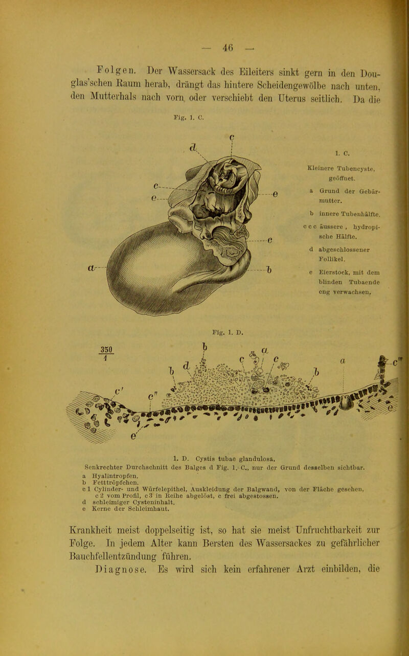 Folgen. Der Wassersack des Eileiters sinkt gern in den Dou- glas'schen Kaum herab, drängt das hintere Scheidengewölbe nach unten, den Mutterhals nach vorn, oder verschiebt den Uterus seitlich. Da dif e ... c 1. c. Kleinere Tubencj-Btc, geöffnet. a Grund der Gebär- mutter. b innere Tubeuhälfte. c c c äussere , hydropi- sohe Hälfte. d abgeschlossener Follikel. e Eierstock, mit dem blinden Tubaende eng verwachsen. 350 Fig. 1. D. a 1. D. Cystis tubae glandulosa. Senkrechter Durchschnitt des Balges d Fig. 1. C, nur der Grund desselben sichtbar, a Hyalintropfen. b Fotttröpl'chen. c 1 Cylinder- und Würfelepithel, Auskleidung der Balgwand, von der Fläche gesehen, c2 vom Profil, c3 in lleihe abgelöst, c frei abgestossen. d schleimiger Cysteninhalt. e Kei-ne der Schleimhaut. Krankheit meist doi)pelseitig ist, so hat sie meist Unfruchtbarkeit zur Folge. In jedem Alter kann Bersten des Wassersackes zu gefährlicher Bauchfellentzündung führen. Diagnose. Es wird sich kein erfahrener Arzt embilden, die