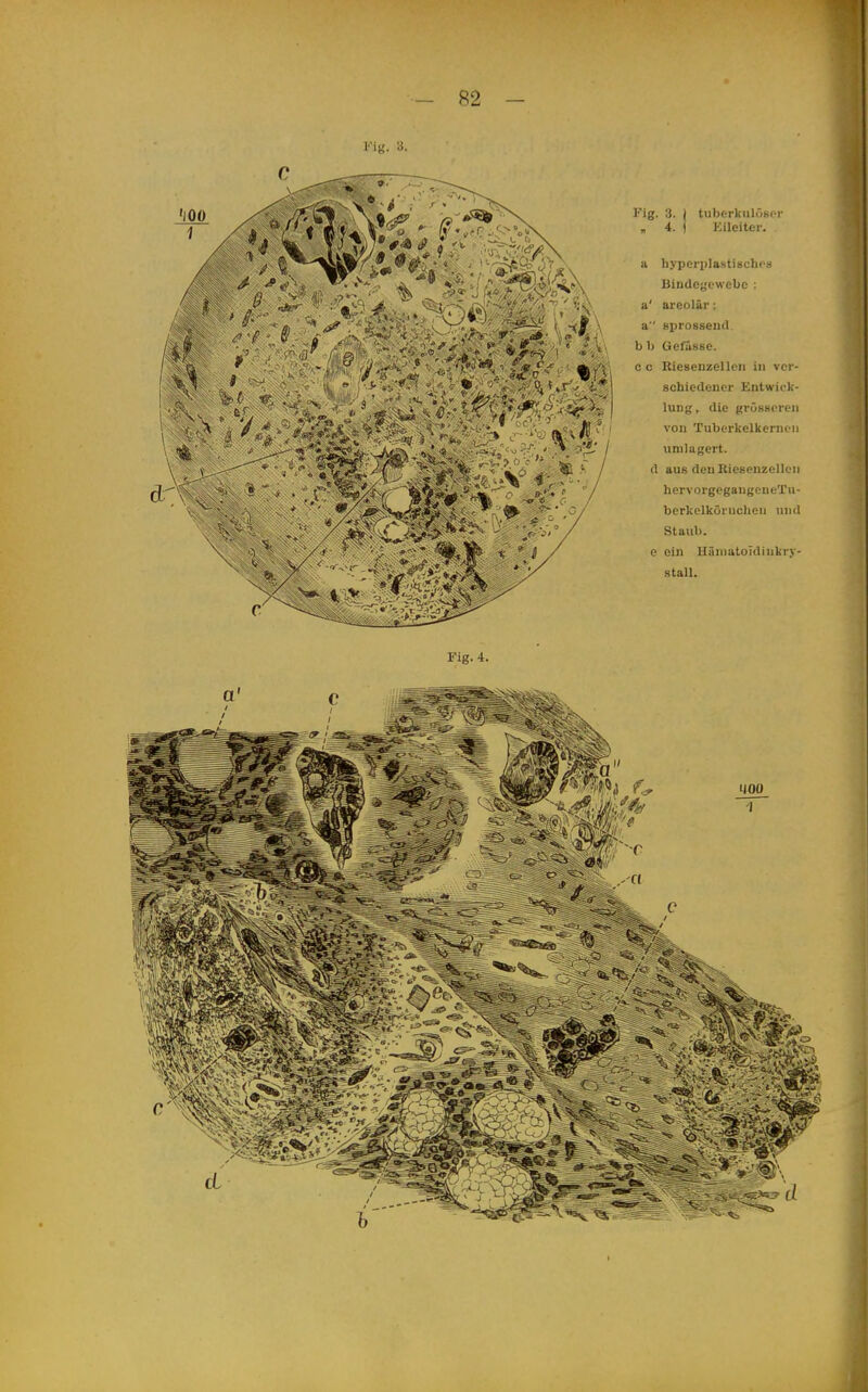 Kig. 3. , 4. tiibftrkiilöKf) Eileiter. a liyperplastigcho» Bindegewebe : a' areolär: a sprosseud. b b Gefässe. o c ßieseuzellen in ver- schiedener Entwick- lung , die grösseren von Tubei'kelkerncn umlagert. d aus denKiesenzellen hervorgegangeneTu- berkelkörnclien und Staub. e ein Häniatoidinkry- stall. Fig. 4.