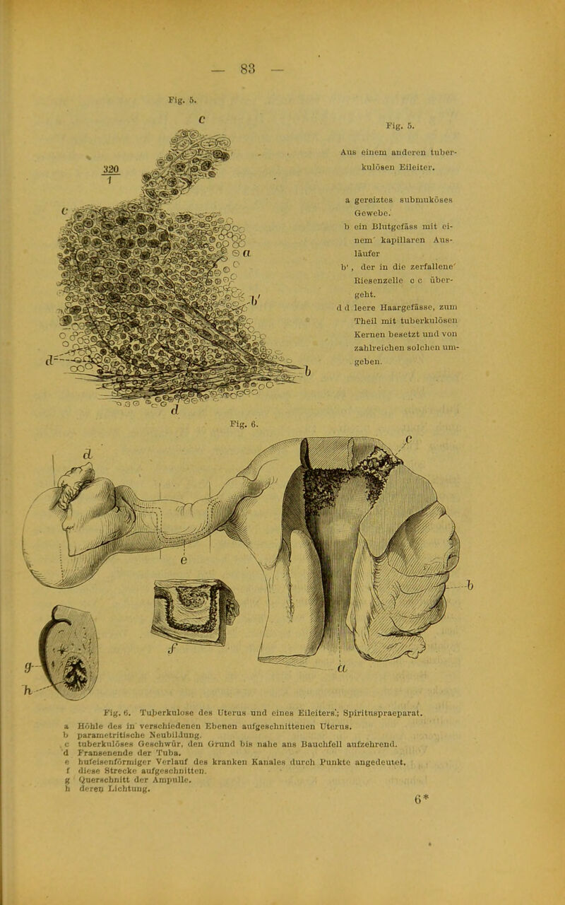 Fig. 5. Fig. 6. Tujjerkulose des Uterus und eines Eileiters!; Spiritnspraeparat. a Höhle des in verschiedenen Ebenen aufgeschuitteuen Uterus, b parametritischc Neubildung. c tuberkulöse« Geschwür, den Gnind bis nahe ans Bauchfell aufzehrend, d Fransenende der Tuba. ft hufeisonförniigcr Verlauf des kranken Kaiiales durch Punkte angedeutet, f diese Strecke aufgeschnitten, g Querschnitt der Ampulle, b derev Lichtung. 6*
