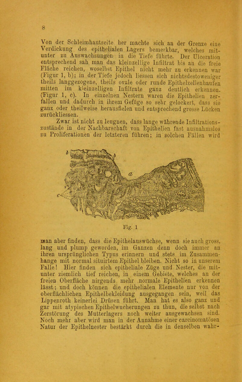 Von der Schleimliautseite her machte sich an der Grenze eine Verdickung des epit^eUalen Lagers bemerkbar, welches mit- unter zu Auswachsungen in die Tiefe führte. Der ülceration entsprechend sah man das kleinzellige Infiltrat bis an die freie Fläche reichen, woselbst Epithel nicht mehr zu erkennen war (Figur 1, b); in der Tiefe jedoch Hessen sich nichtsdestoweniger theils langgezogene, theils ovale oder runde Epithelzellenhaufen mitten im kleinzelligen Infiltrate ganz deutlich erkennen. (Figur 1, c). In einzelnen Nestern waren die Epithelieu zer- fallen und dadurch in ihrem Gefiige so sehr gelockert, dass sie ganz oder theilweise herausfielen und entsprechend grosse Lücken zurückliessen. Zwar ist nicht zu leugnen, dass lange währende Infiltrations- zustände in der Nachbarschaft von Epithelien fast ausnahmslos zu Proliferationen der letzteren führen; in solchen Fällen wird man aber finden, dass die Epithelauswüchse, wenn sie auch gross, lang und plump geworden, im Ganzen denn doch immer au ihren ursprünglichen Typus erinnern und stets im Zusammen- hange mit normal situirtem Epithel bleiben. Nicht so in unserem Falle! Hier finden sich epitheliale Züge und Nester, die mit- unter ziemlich tief reichen, in einem Gebiete, welches an der freien Oberfläche nirgends mehr normale Epithelien erkennen lässt; und doch können die epithelialen Elemente nur von der oberflächlichen Epithelbekleidung ausgegangen sein, weil das Lippenroth keinerlei Drüsen führt. Man hat es also ganz und gar mit atypischen Epithelwucherungen zu thun, die selbst nach Zerstörung des Mutterlagers noch weiter ausgewachsen sind. Noch mehr aber wird man in der Annahme einer carcinomatösen Natur der Epithelnester bestärkt durch die in denselben wahr-