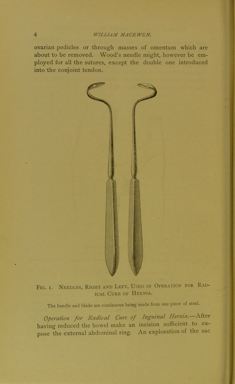 ovarian pedicles or through masses of omentum which are about to be removed. Wood's needle might, however be em- ployed for all the sutures, except the double one introduced into the conjoint tendon. Fig. I. Needles, Right and Left, Used in Operation for Rad- ical Cure of Hernia. The handle and blade are continuous being made from one piece of steel. Operation for Radical Cure of Inguinal Hernia.—Ait&r having reduced the bowel make an incision sufficient to ex- pose the external abdominal ring. An exploration of the sac