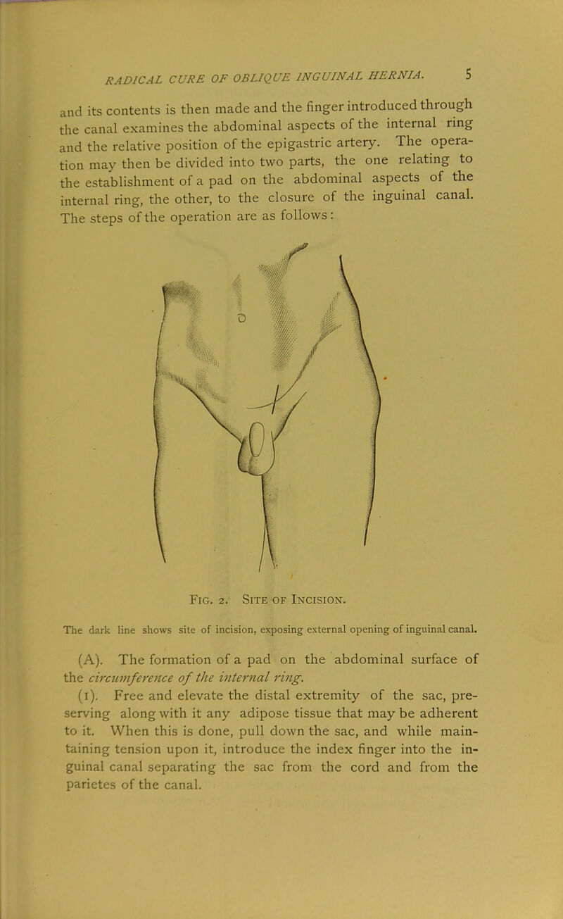 and its contents is then made and the finger introduced through the canal examines the abdominal aspects of the internal ring and the relative position of the epigastric artery. The opera- tion may then be divided into two parts, the one relating to the establishment of a pad on the abdominal aspects of the internal ring, the other, to the closure of the inguinal canal. The steps of the operation are as follows: Fig. 2. Site of Incision. The dark line shows site of incision, exposing external opening of inguinal canal. (A). The formation of a pad on the abdominal surface of the circumference of the iriternal ring. (i). Free and elevate the distal extremity of the sac, pre- serving along with it any adipose tissue that may be adherent to it. When this is done, pull down the sac, and while main- taining tension upon it, introduce the index finger into the in- guinal canal separating the sac from the cord and from the parietes of the canal.