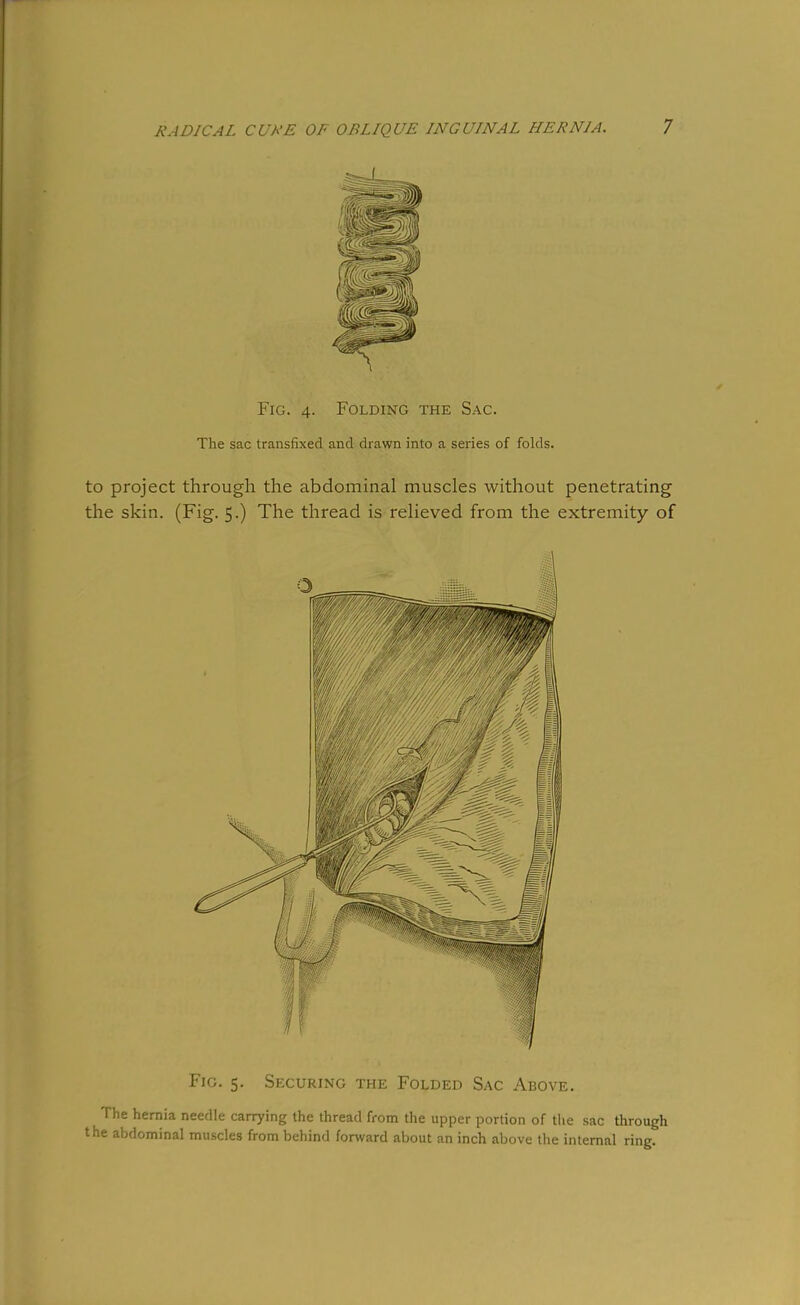 I Fig. 4. Folding the Sac. The sac transfixed and drawn into a series of folds. to project through the abdominal muscles without penetrating the skin. (Fig. 5.) The thread is relieved from the extremity of Fig. 5. Securing the Folded Sac Above. The hernia needle carrying the thread from the upper portion of the sac through the abdominal muscles from bchin'l fonvard about an inch above the internal ring.