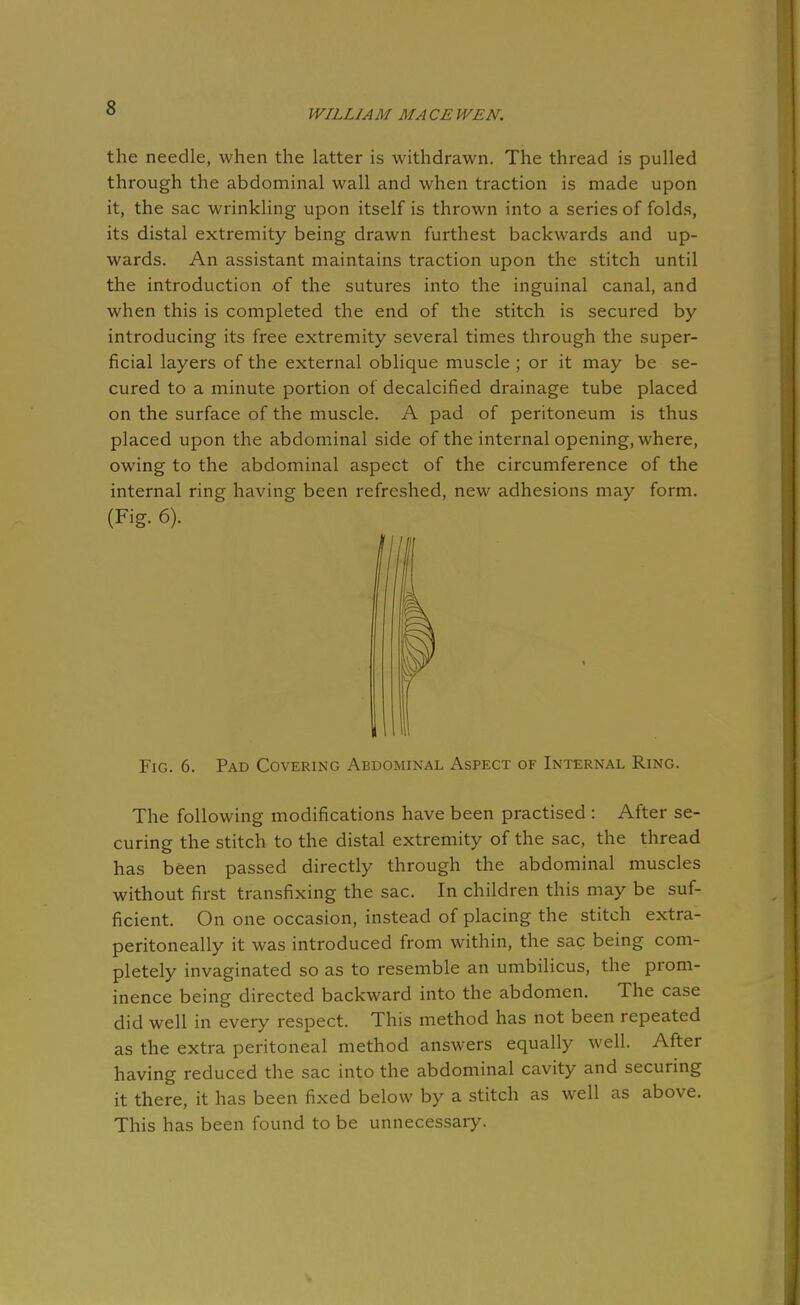 WILLIAM MACE WEN. the needle, when the latter is withdrawn. The thread is pulled through the abdominal wall and when traction is made upon it, the sac wrinkling upon itself is thrown into a series of folds, its distal extremity being drawn furthest backwards and up- wards. An assistant maintains traction upon the stitch until the introduction of the sutures into the inguinal canal, and when this is completed the end of the stitch is secured by- introducing its free extremity several times through the super- ficial layers of the external oblique muscle ; or it may be se- cured to a minute portion of decalcified drainage tube placed on the surface of the muscle. A pad of peritoneum is thus placed upon the abdominal side of the internal opening, where, owing to the abdominal aspect of the circumference of the internal ring having been refreshed, new adhesions may form. The following modifications have been practised : After se- curing the stitch to the distal extremity of the sac, the thread has been passed directly through the abdominal muscles without first transfixing the sac. In children this may be suf- ficient. On one occasion, instead of placing the stitch extra- peritoneally it was introduced from within, the sac being com- pletely invaginated so as to resemble an umbilicus, the prom- inence being directed backward into the abdomen. The case did well in every respect. This method has not been repeated as the extra peritoneal method answers equally well. After having reduced the sac into the abdominal cavity and securing it there, it has been fixed below by a stitch as well as above. This has been found to be unnecessary. (Fig. 6). Fig. 6. Pad Covering Abdominal Aspect of Internal Ring.