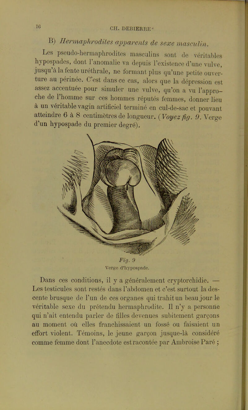 B) Hermaphrodites apparents de sexe masculin. Les pseudo-hermaphrodites masculins sont de véritables hypospades, dont l'anomalie va depuis l'existence d'une vulve, jusqu'à la fente uréthrale, ne formant plus qu'une petite ouver- ture au périnée. C'est dans ce cas, alors que la dépression est assez accentuée pour simuler une vulve, qu'on a vu l'appro- che de l'homme sur ces hommes réputés femmes, donner lieu à un véritable vagin artificiel terminé en cul-de-sac et pouvant atteindre 6 à 8 centimètres de longueur. {Voyez fig. 9. Verge d'un hypospade du premier degré). Fig. 9 Verge d'hypospade. Dans ces conditions, il y a généralement cryptorchidie. — Les testicules sont restés dans l'abdomen et c'est surtout la des- cente brusque de l'un de ces organes qui trahit un beau jour le véritable sexe du prétendu hermaphrodite. Il n'y a personne qui n'ait entendu parler de filles devenues subitement garçons au moment où elles franchissaient un fossé ou faisaient un effort violent. Témoins, le jeune garçon jusque-là considéré comme femme dont l'anecdote est racontée par Ambroise Paré ;