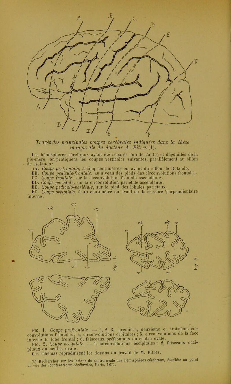 Tracés des principales coupes cérébrales indiquées dans la thèse inaugurale du docteur A. Pitres (1). Les hémisphères cérébraux ayant été séparés l'un de l'autre et dépouillés de la )iie-niôre, on pratiquera les coupes verticales suivantes, parallèlement au sillon de lîolando: AÂ. Coupe prépronlale, à cinq centimètres en avant du sillon de Rolando. BU. Coupe pediculo-frontale, au niveau des pieds des circonvolutions frontales, ce. Coupe frontale, sur la circonvolution frontale ascendante. DD. Coupe pariétale, sur la circonvolution pariétale ascendante. EE. Coupe pediculo-parlétale, sur le pied des lobules pariétaux. FF. Coupe occipitale, à un centimètre en avant de la scissure 'perpendiculaire interne. Fie. 1. Coupe préfrontale. — \,-2, Z, première, deuxième et troisième cir- convolutions frontales ; 4, circonvolutions orbitaires ; 5, circonvolutions de la face interne du lobe frontal ; 6, faisceaux préfrontaux du centre ovale. FiG. 2. Coupe occipitale. — 1, circonvolutions occipitales; 2, faisceaux occi- pitaux du centre ovale. Ces schémas reproduisent les dessins du travail de M. Pitres. (1) Recherches sur les lésions du centre ovale dos liémisphères cérébraux, étudiées au point de vue des localisations cérébrales, Pnrîs, 1877.