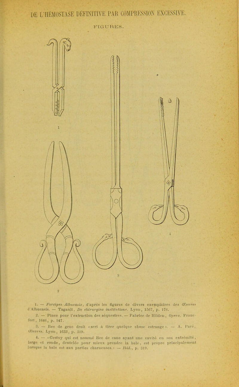 DE L llKMOSlASE DKblNITlVE PAR COMI'KKSSION KXCKSSIVK. IMG V'RViS. 1. — Forcipen Albucanis, d'après les figures de divers exemplairos (1rs Œiivrei l AIbncasi». — Tagault, De chirttrgica institution^. Lyon, 1507, p. I7li. iS. — Pince pour l'extraotioii dos s<''fiiifsf.rfp. — Fnbrico dp Tlildni, Opéra. l''i-:iiic fort, 1040, p. 947. '■'>■ — l'ec de grtif! droil «sort à (iror iiuolciiic cliosc estrango •. — A. l'Jirr, iKiivr'n. ;,yoii, 1033, ]). 31!). t. — 'Oculiiy rjni ont iininiiK! lîoc dr- caiin ayant une cavitc; en hou cxlri'iiiilt:, large i-t ronde, dcntfliM' jionr niit-nx prcndri^ la biilc, ost iirnpro priiicipalrniiuit i'jnqne la bain est aux parties ctiarneiise».• — Ibiil.. p. .'il!i.