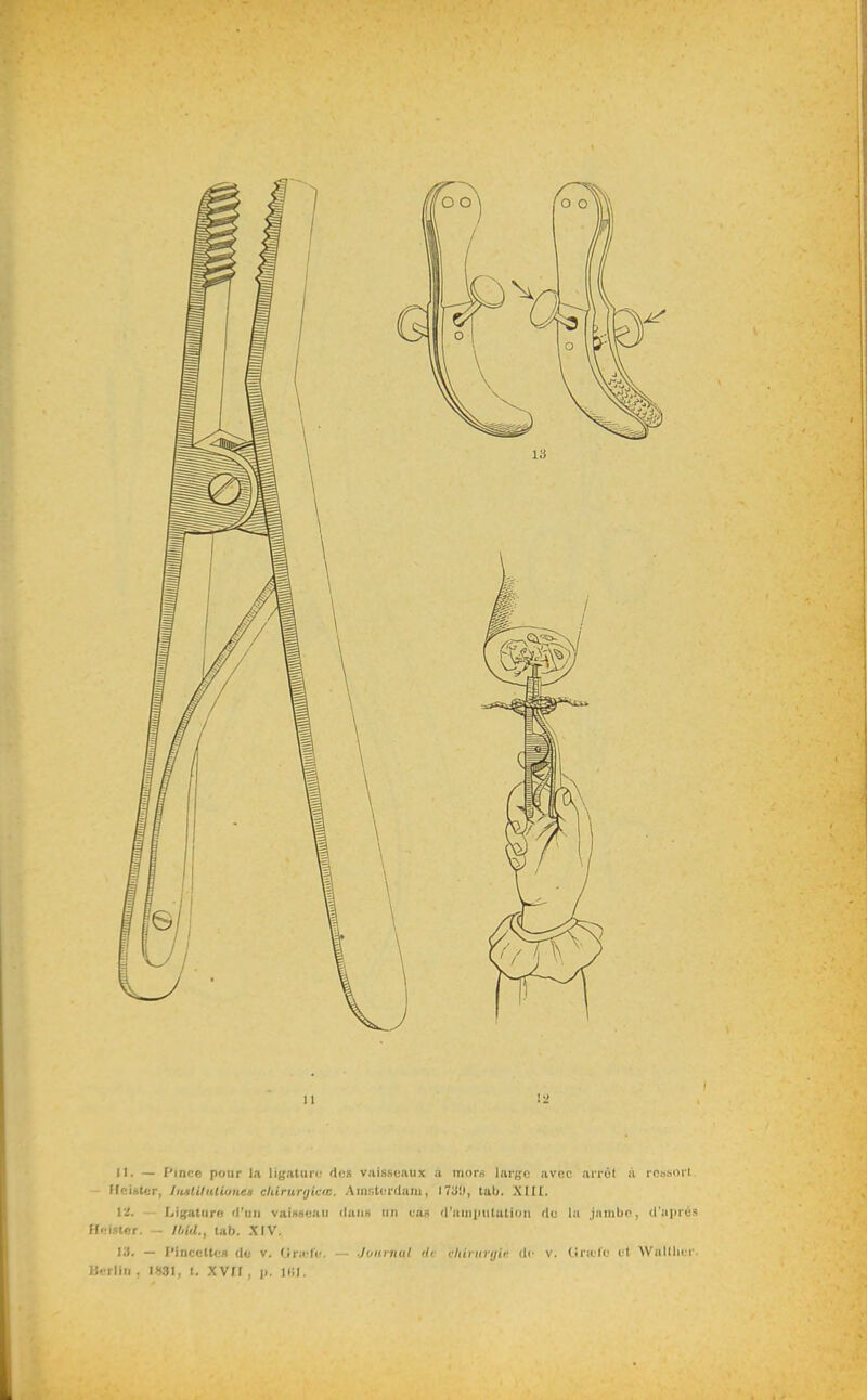 II. — l'ince pour l.i ligature dt:s vaisseaux a mors large avec arrùl à robsoil ffeiater, IiitlillUionen cUirurijivw. Ainstc^rdani, l7y!J, tab. XIIt. liS. — Ligatiirri «l'un vainseaii ilaiis un cas 'l'iiiiipiilaliiiii do l.i j.iinlio. d'iiprcs ff<!ifltcr. — lOld., tab. XIV. 13. — l'inccttei) do v. Gr;i lc. -- Joiiniul 'li chiniitjir de v. (iiiilo cl Walllii r Berlin . 1831, t. XVII , i». Uii.