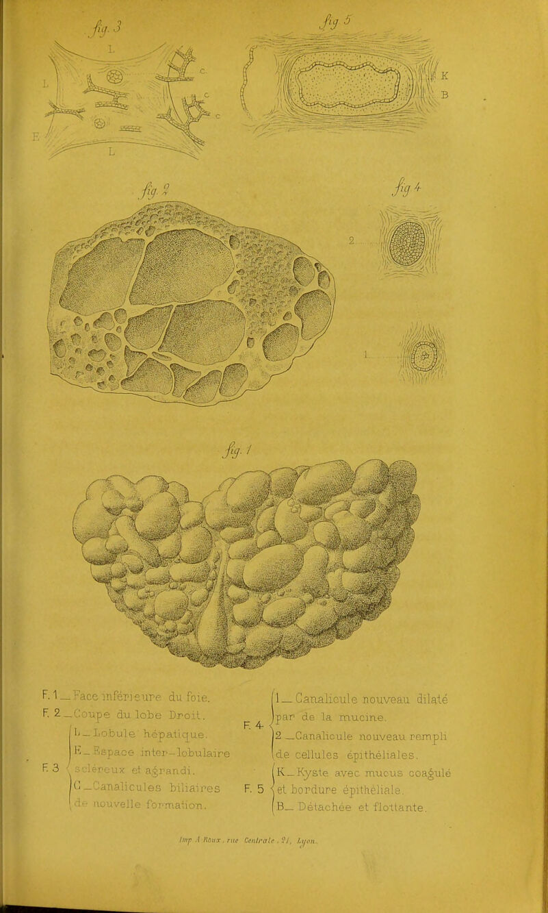 F. 1 _ Face inférieure du foie. F. 2_Coupe du lobe Droit. Il— Lobule' hépatic[ue. •''■'■■mo intoT'--lobulaire F 3 m;-oanalicules biliaires de nouvelle formation. F. 4- F. 5 li_ Ganalicule nouveau dilalé jpar de la mucme. 12 _GaT\alicule nouveau rempli Ide cellules épathéJiales. K_ Kyste avec mucus coagulé \ et bordure épithéliale. B_ Détachée et flo-llante. Imp .1 KniiT. ntc Cciili-alf . '.'/, /.y.ui