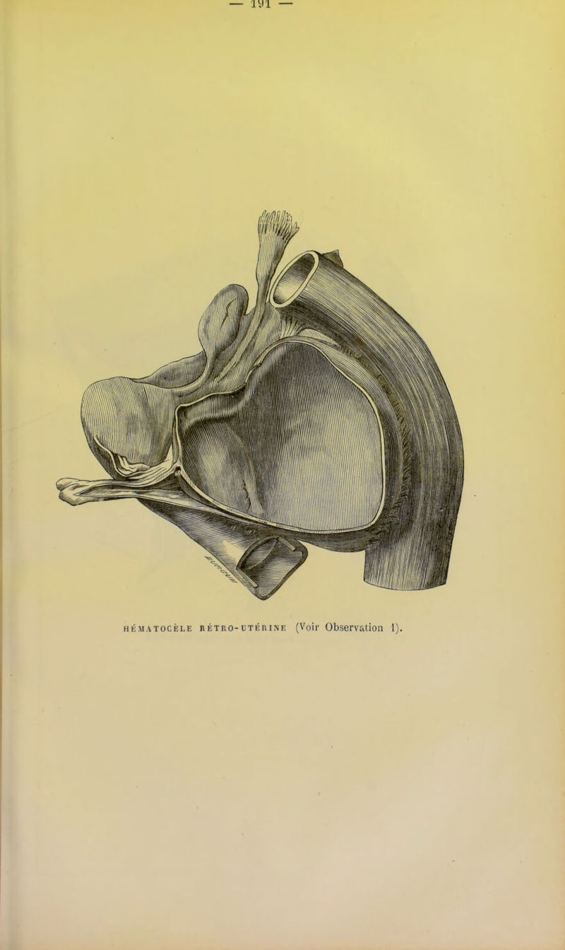 — iyi — hématocèle rétuo -uTÉuiNE (Voir Observation 1).