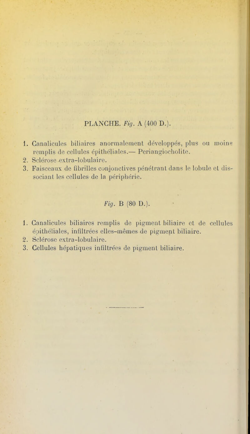 PLANGHE. Fig. A (400 D.). 1. Ganalicules biliaires anormaloment developpes, plus on moins romplis de cellules epitheliales.— Periangiocholite. 2. Sclerose .extra-lobulaire. 3. Faisceaux de fibrilles conjonctives penetrant dans le lobule ot dis- sociant les cellules de la peripherie. Fig. B (80 D.). 1. Ganalicules biliaires remplis de piixment biliaire ot de cellules epitheliales, inPdtrees elles-memes de pigment biliaire. 2. Sclerose extra-lobulaire. 3. Cellules hepatiques infiltrees de pigment biliaire.