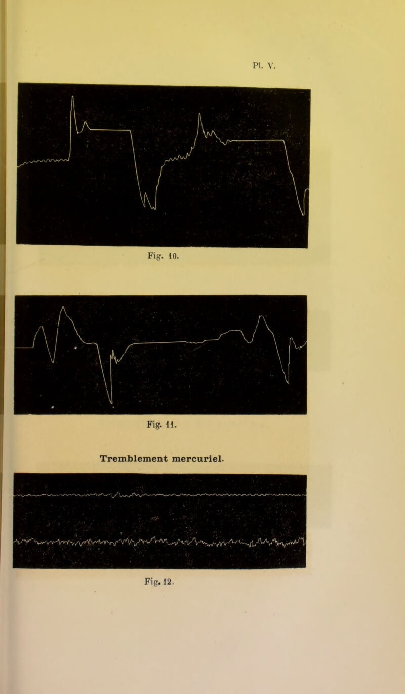 Fig. i\. Tremblement mercuriel.