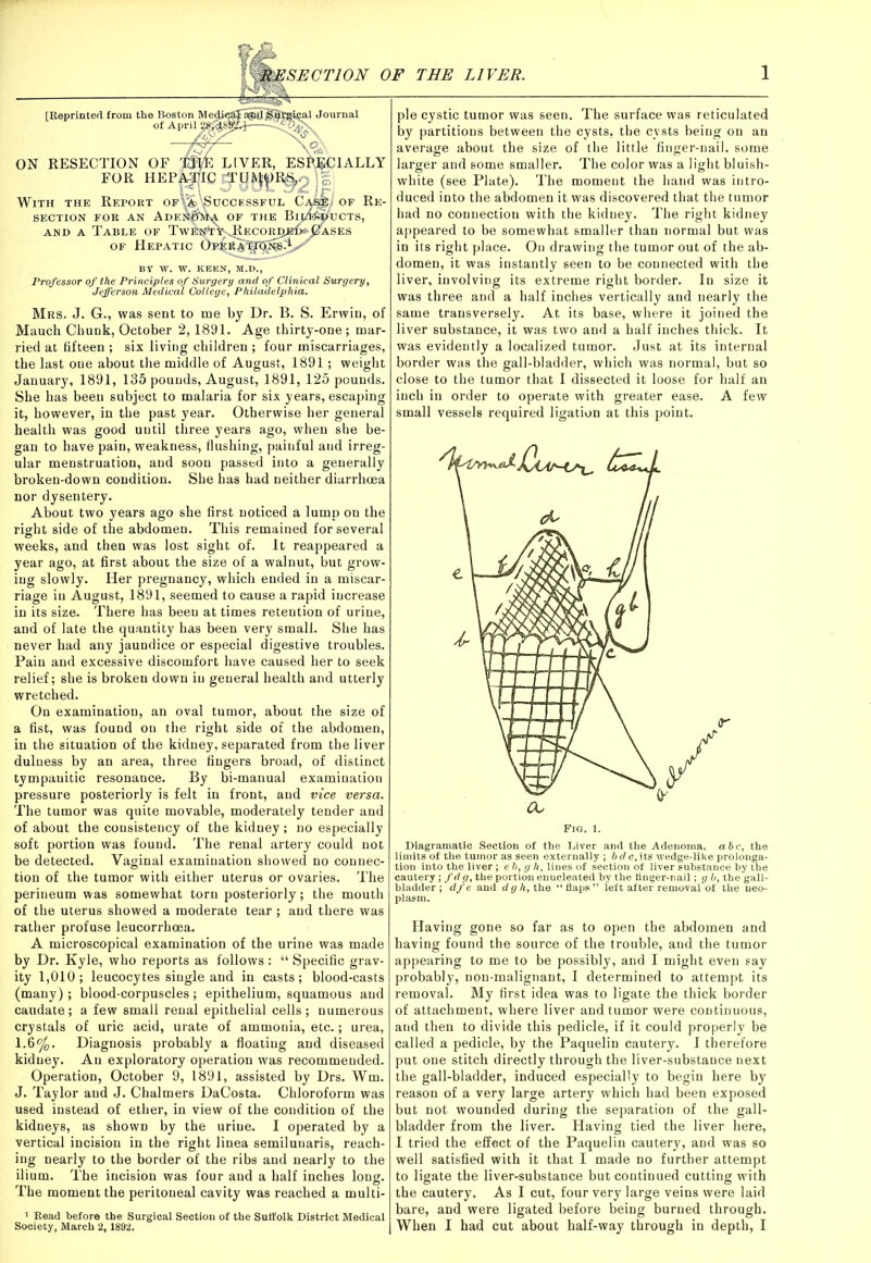 [Reprinted from the Boston Medj<^S5^fltgieal Journal of April ON RESECTION OF THE LIVER, ESPECIALLY FOR HEP^Digjo With the Report of\^,'Successful Cas®< of Re- section FOR AN AdeMm OF THE Bl0O«>UCTS, and a Table of TwFN'tV^ecor^b^s^ases of Hepatic OpIrJ^JF^s^/ BY W. W. KEEN, M.D., Professor of the Principles of Surgery and of Clinical Surgery, Jefferson Medical College, Philadelphia. Mrs. J. G., was sent to me by Dr. B. S. ErwiD, of Mauch Chunk, October 2,1891. Age thirty-one; mar- ried at fifteen ; six living children ; four miscarriages, the last one about the middle of August, 1891; weight January, 1891, 135 pounds, August, 1891, 125 pounds. She has been subject to malaria for six years, escaping it, however, in the past year. Otherwise her general health was good until three years ago, when she be- gan to have pain, weakness, flushing, painful and irreg- ular menstruation, and soon passed into a generally broken-down condition. She has had neither diarrhoea nor dysentery. About two years ago she first noticed a lump on the right side of the abdomen. This remained for several weeks, and then was lost sight of. It reappeared a year ago, at first about the size of a walnut, but grow- ing slowly. Her pregnancy, which ended in a miscar- riage in August, 1891, seemed to cause a rapid increase in its size. There has been at times retention of urine, and of late the quantity has been very small. She has never had any jaundice or especial digestive troubles. Pain and excessive discomfort have caused her to seek relief; she is broken down in general health and utterly wretched. On examination, an oval tumor, about the size of a fist, was found on the right side of the abdomen, in the situation of the kidney, separated from the liver dulness by an area, three fingers broad, of distinct tympanitic resonance. By bi-manual examination pressure posteriorly is felt in front, and vice versa. The tumor was quite movable, moderately tender and of about the consistency of the kidney; no especially soft portion was found. The renal artery could not be detected. Vaginal examination showed no connec- tion of the tumor with either uterus or ovaries. The perineum was somewhat torn posteriorly; the mouth of the uterus showed a moderate tear ; and there was rather profuse leucorrhcea. A microscopical examination of the urine was made by Dr. Kyle, who reports as follows: “ Specific grav- ity 1,010; leucocytes single and in casts; blood-casts (many) ; blood-corpuscles; epithelium, squamous and caudate; a few small renal epithelial cells; numerous crystals of uric acid, urate of ammonia, etc.; urea, I. 6%. Diagnosis probably a floating and diseased kidney. An exploratory operation was recommended. Operation, October 9, 1891, assisted by Drs. Wm. J. Taylor and J. Chalmers DaCosta. Chloroform was used instead of ether, in view of the condition of the kidneys, as shown by the urine. I operated by a vertical incision in the right linea semilunaris, reach- ing nearly to the border of the ribs and nearly to the ilium. The incision was four and a half inches long. The moment the peritoneal cavity was reached a multi- 1 Read before the Surgical Section of the Suffolk District Medical pie cystic tumor was seen. The surface was reticulated by partitions between the cysts, the cysts being on an average about the size of the little finger-nail, some larger and some smaller. The color was a light bluish- white (see Plate). The momeut the hand was intro- duced into the abdomen it was discovered that the tumor had no connection with the kidney. The right kidney appeared to be somewhat smaller than normal but was in its right place. On drawing the tumor out of the ab- domen, it was instantly seen to be connected with the liver, involving its extreme right border. In size it was three and a half inches vertically and nearly the same transversely. At its base, where it joined the liver substance, it was two and a half inches thick. It was evidently a localized tumor. Just at its internal border was the gall-bladder, which was normal, but so close to the tumor that I dissected it loose for half an inch in order to operate with greater ease. A few small vessels required ligation at this point. Diagramatic Section of the Liver and the Adenoma, abc, the limits of the tumor as seen externally ; bdc, its wedge-like prolonga- tion into the liver ; eb, g h, lines of section of liver substance by the cautery ; fd g, the portion enucleated hy the finger-nail; g b, the gall- bladder ; dfe and dgh, the “flaps” left after removal of the neo- plasm. Having gone so far as to open the abdomen and having found the source of the trouble, and the tumor appearing to me to be possibly, and I might even say probably, non-malignant, I determined to attempt its removal. My first idea was to ligate the thick border of attachment, where liver and tumor were continuous, and then to divide this pedicle, if it could properly be called a pedicle, by the Paquelin cautery. I therefore put one stitch directly through the liver-substance next the gall-bladder, induced especially to begin here by reason of a very large artery which had been exposed but not wounded during the separation of the gall- bladder from the liver. Having tied the liver here, I tried the effect of the Paquelin cautery, and was so well satisfied with it that I made no further attempt to ligate the liver-substance but continued cutting with the cautery. As I cut, four very large veins were laid bare, and were ligated before being burned through.