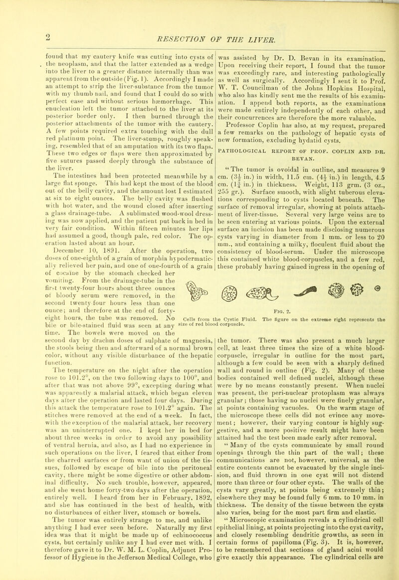 found that my cautery knife was cutting into cysts of the neoplasm, and that the latter extended as a wedge into the liver to a greater distance internally than was apparent from the outside (Fig. 1). Accordingly I made an attempt to strip the liver-substance from the tumor with my thumb nail, and found that I could do so with perfect ease and without serious haemorrhage. This enucleation left the tumor attached to the liver at its posterior border only. I then burned through the posterior attachments of the tumor with the cautery. A few points required extra touching with the dull red platinum point. The liver-stump, roughly speak- ing, resembled that of an amputation with its two flaps. These two edges or flaps were then approximated by five sutures passed deeply through the substance of the liver. The intestines had been protected meanwhile by a large flat sponge. This had kept the most of the blood out of the belly cavity, and the amount lost I estimated at six to eight ounces. The belly cavity was flushed with hot water, and the wound closed after inserting a glass drainage-tube. A sublimated wood-wool dress- ing was now applied, and the patient put back in bed in very fair condition. Within fifteen minutes her lips had assumed a good, though pale, red color. The op- eration lasted about an hour. December 10, 1891. After the operation, two doses of onereighth of a grain of morphia hypodermatic- ally relieved her pain, and one of one-fourth of a grain of cocaine by the stomach checked her vomiting. From the drainage-tube in the first twenty-four hours about three ounces of bloody serum were removed, in the second twenty-four hours less than one ounce; and therefore at the end of forty- eight hours, the tube was removed. No bile or bile-stained fluid was seen at any time. The bowels were moved on the second day by drachm doses of sulphate of magnesia, the stools being then and afterward of a normal brown color, without any visible disturbance of the hepatic function. The temperature on the night after the operation rose to 101.2°, on the two following days to 100°, and after that was not above 99°, excepting during what was apparently a malarial attack, which began eleven days after the operation and lasted four days. During this attack the temperature rose to 101.2° again. The stitches were removed at the end of a week. In fact, with the exception of the malarial attack, her recovery was an uninterrupted one. I kept her in bed for about three weeks in order to avoid any possibility of ventral hernia, and also, as I had no experience in such operations on the liver, I feared that either from the charred surfaces or from want of union of the tis- sues, followed by escape of bile into the peritoneal cavity, there might be some digestive or other abdom- inal difficulty. No such trouble, however, appeared, and she went home forty-two days after the operation, entirely well. I heard from her in February, 1892, and she has continued in the best of health, with no disturbances of either liver, stomach or bowels. The tumor was entirely strange to me, and unlike anything I had ever seen before. Naturally my first idea was that it might be made up of echinococcus cysts, but certainly unlike any I had ever met with. I therefore gave it to Dr. W. M. L. Coplin, Adjunct Pro- fessor of Hygiene in the Jefferson Medical College, who was assisted by Dr. D. Bevan in its examination. Upon receiving their report, I found that the tumor was exceedingly rare, and interesting pathologically as well as surgically. Accordingly I sent it to Prof. W. T. Councilman of the Johns Hopkins Hospital, who also has kindly sent me the results of his examin- ation. I append both reports, as the examinations were made entirely independently of each other, and their concurrences are therefore the more valuable. Professor Coplin has also, at my request, prepared a few remarks on the pathology of hepatic cysts of new formation, excluding hydatid cysts. PATHOLOGICAL REPORT OF PROF. COPLIN AND DR. BEVAN. “ The tumor is ovoidal in outline, and measures 9 cm. (3-|- in.) in width, 11.5 cm. (4£ in.) in length, 4.5 cm. (If in.) in thickness. Weight, 113 grm. (3 oz., 255 gr.). Surface smooth, with slight tuberous eleva- tions corresponding to cysts located beneath. The surface of removal irregular, showing at points attach- ment of liver-tissue. Several very large veins are to be seen entering at various points. Upon the external surface an iucision has been made disclosing numerous cysts varying in diameter from 1 mm. or less to 20 mm., and containing a milky, floculent fluid about the consistency of blood-serum. Under the microscope this contained white blood-corpuscles, and a few red, these probably having gained ingress in the opening of the tumor. There was also present a much larger cell, at least three times the size of a white blood- corpuscle, irregular in outline for the most part, although a few could be seen with a sharply defined wall and round in outline (Fig. 2). Many of these bodies contained well defined nuclei, although these were by no means constantly present. When nuclei was present, the peri-nuclear protoplasm was always granular; those having no nuclei were finely granular, at points containing vacuoles. On the warm stage of the microscope these cells did not evince any move- ment ; however, their varying contour is highly sug- gestive, and a more positive result might have been attained had the test been made early after removal. “ Many of the cysts communicate by small round openings through the thin part of the wall; these communications are not, however, universal, as the entire contents cannot be evacuated by the single inci- sion, and fluid thrown in one cyst will not distend more than three or four other cysts. The walls of the cysts vary greatly, at points being extremely thin; elsewhere they may be found fully 6 mm. to 10 mm. in thickness. The density of the tissue between the cysts also varies, being for the most part firm and elastic. “ Microscopic examination reveals a cylindrical cell epithelial lining, at points projecting into the cyst cavity, and closely resembling dendritic growths, as seen in certain forms of papilloma (Fig. 3). It is, however, to be remembered that sections of gland acini would give exactly this appearance. The cylindrical cells are Fig. 2. Cells from the Cystic Fluid. The figure on the extreme right represents the size of red blood corpuscle.