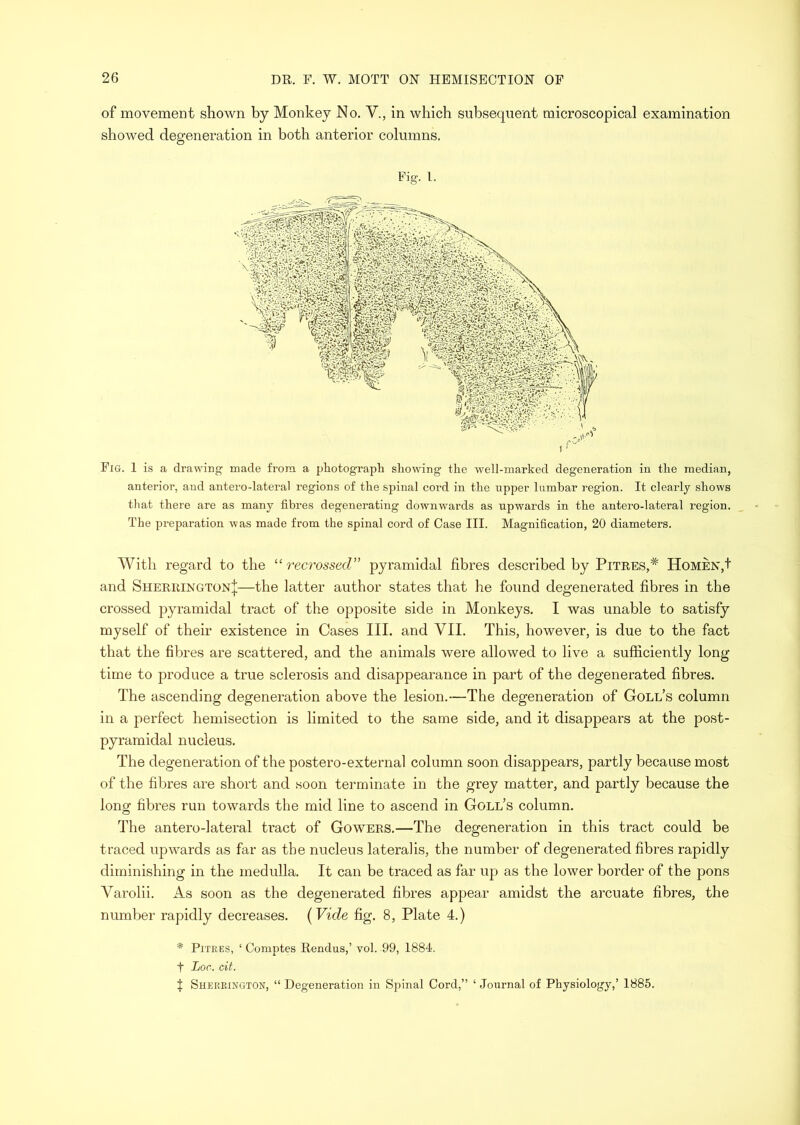 of movement shown by Monkey No. V., in which subsequent microscopical examination showed degeneration in both anterior columns. Fig. 1. Fig. 1 is a drawing made from a photograph showing the well-marked degeneration in the median, anterior, and antero-lateral regions of the spinal cord in the upper lumbar region. It clearly shows that there are as many fibres degenerating downwards as upwards in the antero-lateral region. The preparation was made from the spinal cord of Case III. Magnification, 20 diameters. With regard to the recrossed” pyramidal fibres described by Pitres,* HoMEX,t and Sherrington;];—the latter author states that he found degenerated fibres in the crossed pyramidal tract of the opposite side in Monkeys. I was unable to satisfy myself of their existence in Cases III. and VII. This, however, is due to the fact that the fibres are scattered, and the animals were allowed to live a sufficiently long time to produce a true sclerosis and disappearance in part of the degenerated fibres. The ascending degeneration above the lesion.—The degeneration of Goll’s column in a perfect hemisection is limited to the same side, and it disappears at the post- pyramidal nucleus. The degeneration of the postero-external column soon disappears, partly because most of the fibres are short and soon terminate in the grey matter, and partly because the long fibres run towards the mid line to ascend in Goll’s column. The antero-lateral tract of Gowers.—The degeneration in this tract could be traced upwards as far as the nucleus lateralis, the number of degenerated fibres rapidly diminishing in the medulla. It can be traced as far up as the lower border of the pons Varolii. As soon as the degenerated fibres appear amidst the arcuate fibres, the number rapidly decreases. {Vide fig. 8, Plate 4.) * Pitres, ‘ Comptes Rendus,’ vol. 99, 1884. t Lor. cit. I Sherrington, “ Degeneration in Spinal Cord,” ‘ Journal of Physiology,’ 1885.