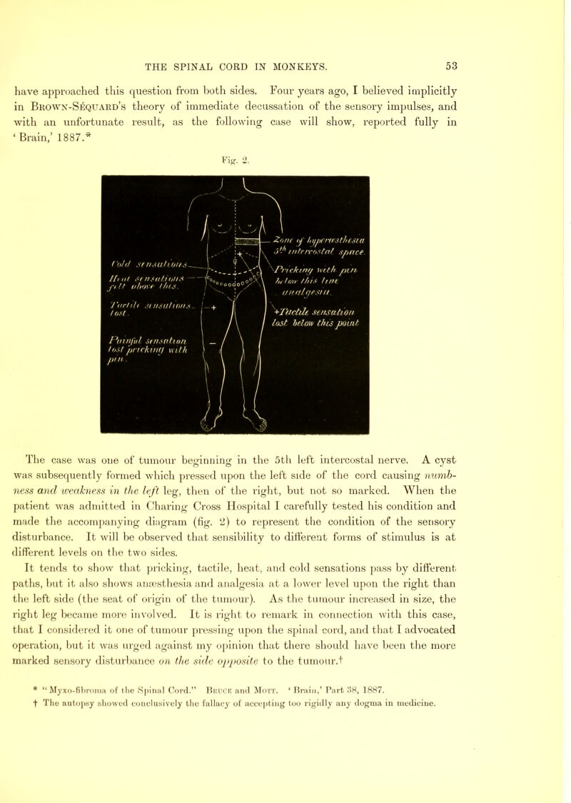 have approached this question from both sides. Four years ago, I believed implicitly in Brown-Sequard’s theory of immediate decussation of the sensory impulses, and with an unfortunate result, as the following case will show, reported fully in ‘ Brain,’ 1887.'^ Fig. 2. The case was oue of tumour beginning in the 5th left intercostal nerve. A cyst was subsequently formed which pressed upon the left side of the cord causing numb- ness and iveahiess in the left leg, then of the right, but not so marked. When the patient was admitted in Charing Cross Hospital I carefully tested his condition and made the accompanying diagram (fig. 2) to represent the condition of the sensory disturbance. It will be observed that sensibility to different forms of stimulus is at different levels on tlie two sides. It tends to show that pricking, tactile, heat, and cold sensations pass by different paths, hut it also shows anaesthesia and analgesia at a lower level upon the right than the left side (the seat of origin of the tumour). As the tumour increased in size, the right leg became more involved. It is right to remark in connection Avith this case, that I considered it one of tumour pressing upon the spinal cord, and that I advocated operation, but it was urged against my opinion that tliere should have been the more marked sensory disturbance on the side opposite to the tumour.t * “ Myxo-fihroina of tlie Spinal Corel.” BiiUCR and Mott. ‘ Drain,’ Part 38, 1887. t The autopay showed c(;nclusively the fallacy of accc])ting too rigidly any dogma in medicine.