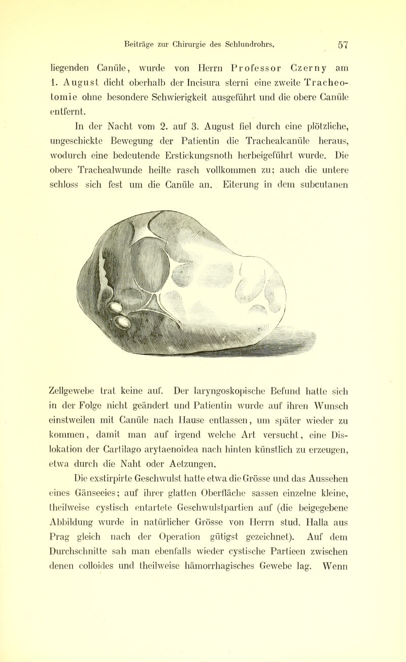 liegenden Ganüle, wurde von Herrn Professor Czerny am 1. August dicht oberhalb der Incisura sterni eine zweite Tracheo- tomie ohne besondere Schwierigkeit ausgeführt und die obere Canüle entfernt. In der Nacht vom 2. auf 3. August fiel durch eine plötzliche, ungeschickte Bewegung der Patientin die Trachealcanüle heraus, wodurch eine bedeutende Erstickungsnoth herbeigeführt wurde. Die obere Trachealwunde heilte rasch vollkommen zu; auch die untere schloss sich fest um die Ganüle an. Eiterung in dem subcutanen Zellgewebe trat keine auf. Der laryngoskopische Befund hatte sich in der Folge nicht geändert und Patientin wurde auf ihren Wunsch einstweilen mit Canüle nach Hause entlassen, um später wieder zu kommen, damit man auf irgend welche Art versucht, eine Dis- lokation der Cartilago arytaenoidea nach hinten künstlich zu erzeugen, etwa durch die Naht oder Aetzungen. Die exstirpirte Geschwulst hatte etwa die Grösse und das Aussehen eines Gänseeies; auf ihrer glatten Oberfläche sassen einzelne kleine, theilweise cystisch entartete Geschwulstpartien auf (die beigegebene Abbildung wurde in natürlicher Grösse von Herrn stud. Halla aus Prag gleich nach der Operation gütigst gezeichnet). Auf dem Durchschnitte sah man ebenfalls wieder cystische Partieen zwischen denen colloides und theilweise hämorrhagisches Gewebe lag. Wenn