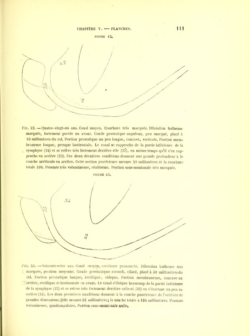 FIGURE 42, Fig. A2.—Quatre-vingt-im ans. Canal moyen. Courbure très marquée. Dilatation bulbeuse marquée, fortement portée en avant. Coude prostatique anguleux, peu marqué, placé 5 16 millimètres du col. Portion prostatique un peu longue, concave, verticale. Portion mem- braneuse longue, presque horizontale. Le canal se rapproche de la partie inférieure de la symphyse (U) et se relève très fortement derrière elle (35), en même temps qu’il s’en rap- proche en arrière (23). Ces deux dernières conditions donnent une grande profondeur cà la courbe uréthrale en arrière. Cette section postérieure mesure f|9 millimètres et la courbure totale 100. Prostate très volumineuse, réniforme. Portion sous-montanale très marquée. FIGURE 43. Fig. 43. —Soixante-seize ans. Canal moyen, courbure prononcée. Dilatation bulbeuse très , marquée, position moyenne. Coude prostatique arrondi, effacé, placé à 30 millimètres du col. Portion prostatique longue, rectiligne, oblique. Portion membraneuse, concave en , ( arrière, rectiligne et horizontale en avant. Le canal s’éloigne beaucoup de-la partie inférieure de la symphyse (22) et se relève très fortement derrière celle-ci (36) en s’écartant un peu eu arrière (34). Les deux premières conditions donnent à la courbe postérieure de rurctbre de grandes dimensions jjelle mesure 52 millimètres; la courbe totale a 105 millimètres. Prostate volumineuse, quadrangulaire. Portion sous-montanale nulle.