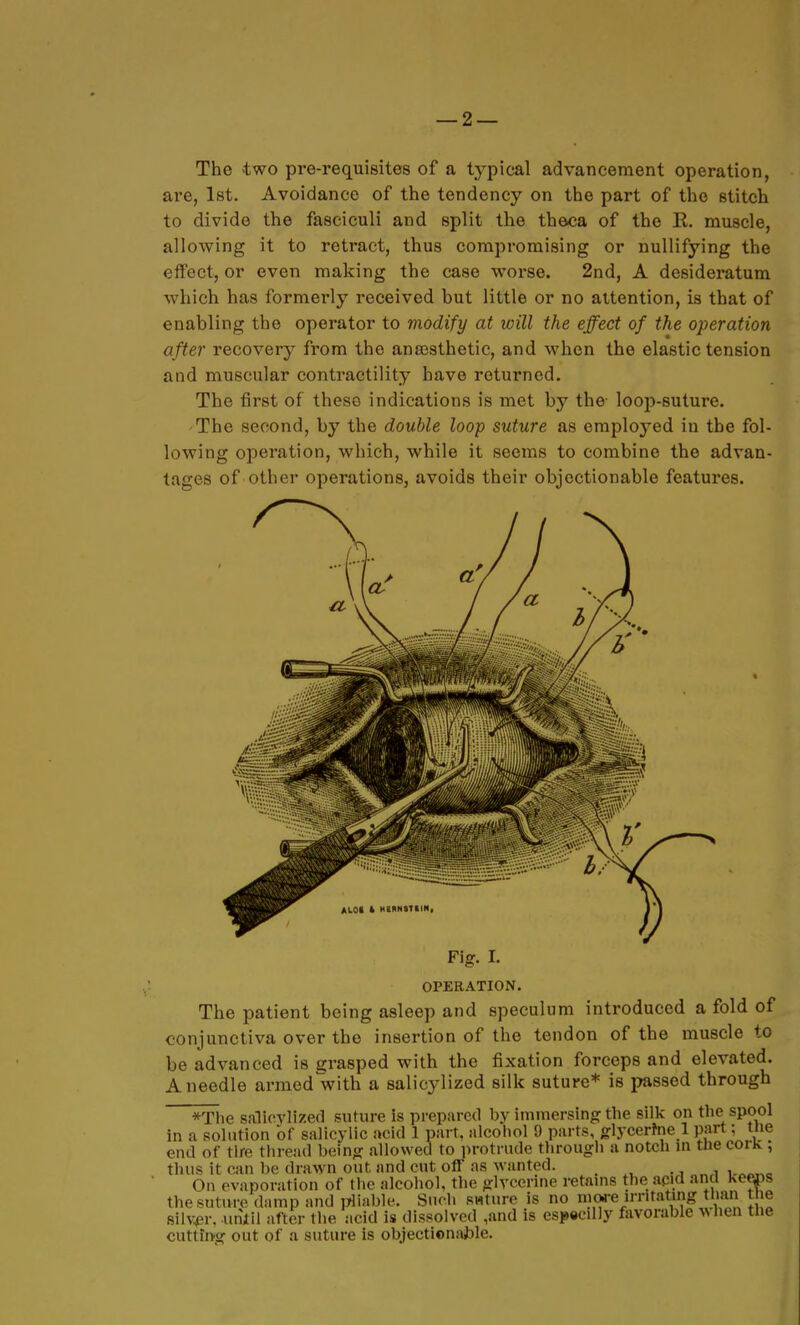 The two pre-requisites of a typical advancement operation, are, let. Avoidance of the tendency on the part of the stitch to divide the fasciculi and split the theca of the R. muscle, allowing it to retract, thus compromising or nullifying the effect, or even making the case worse. 2nd, A desideratum which has formerly received hut little or no attention, is that of enabling the operator to modify at will the effect of the operation a fter recovery from the anajsthetic, and when the elastic tension and muscular contractility have returned. The first of these indications is met by the loop-suture. The second, by the double loop suture as employed in the fol- lowing operation, which, while it seems to combine the advan- tages of other operations, avoids their objectionable features. Fig. I. OPERATION. The patient being asleep and speculum introduced a fold of conjunctiva over the insertion of the tendon of the muscle to be advanced is grasped with the fixation forceps and elevated. A needle armed with a salicylized silk suture* is passed through *Tiie salicylized suture is prepared by immersing the sillc on the spool in a solution of salicylic acid 1 part, alcohol 9 parts, glycerfne 1 part; tne end of tire tliread being allowed to protrude tlirougii a notch \n tlie corK ; tluis it can be dra\yn out and cut off as wanted. the! siivtpr, 11 . cutting out of a suture is objectionable.