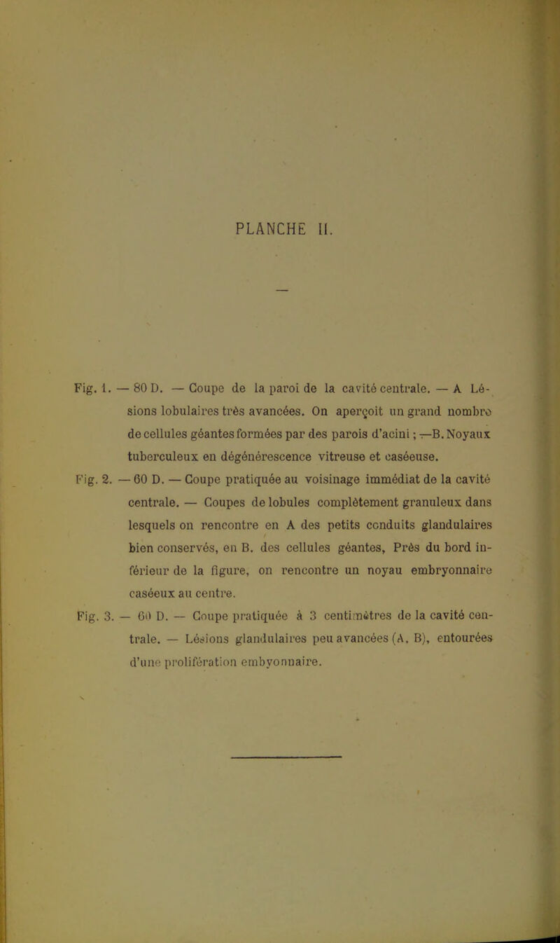 Fig. 1. — 80 D. — Coupe de la paroi de la cavité centrale. — A Lé- sions lobulaires très avancées. On aperçoit un grand nombre de cellules géantes formées par des parois d'acini ; ^-B. Noyaux tuberculeux en dégénérescence vitreuse et caséeuse. Fig. 2. — 60 D. — Coupe pratiquée au voisinage immédiat de la cavité centrale. — Coupes de lobules complètement granuleux dans lesquels on rencontre en A des petits conduits glandulaires bien conservés, en B. des cellules géantes, Près du bord in- férieur de la figure, on rencontre un noyau embryonnaire caséeux au centre. Fig, 3. _ Q(\ d. — Coupe pratiquée à 3 centimètres de la cavité cen- trale. — Lésions glandulaires peu avancées (A. B), entourées d'une; prolifération embyonnaire.