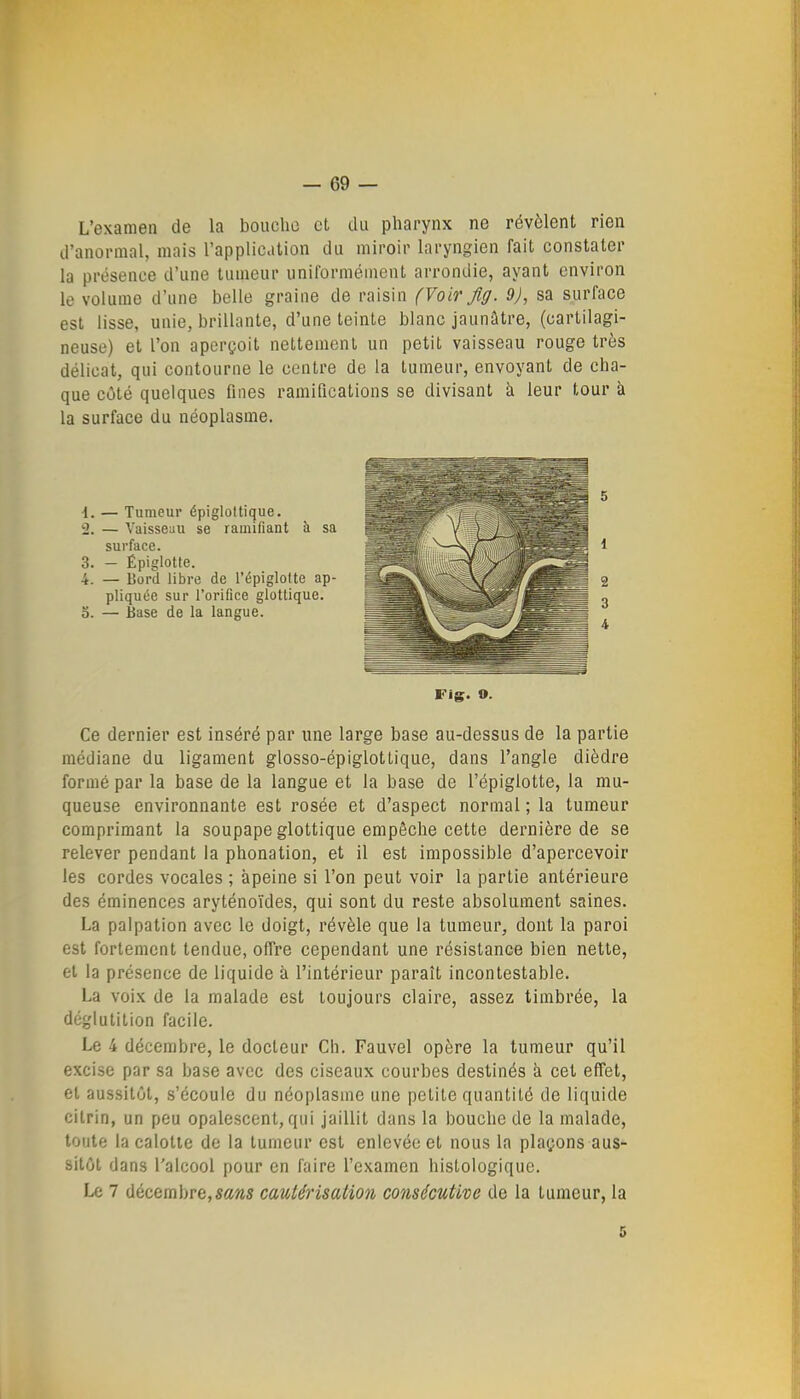 L'examen de la bouche et du pharynx ne révèlent rien d'anormal, mais l'applioalion du miroir laryngien fait constater la présence d'une tumeur uniformément arrondie, ayant environ le volume d'une belle graine de raisin (Voirjig. 9J, sa surface est lisse, unie, brillante, d'une teinte blanc jaunâtre, (cartilagi- neuse) et l'on aperçoit nettement un petit vaisseau rouge très délicat, qui contourne le centre de la tumeur, envoyant de cha- que côté quelques fines ramifications se divisant à leur tour à la surface du néoplasme. •1. — Tumeur épigloltique. 2. — Vaisseau se ramifiant à sa surface. 3. - Épiglotte. 4. — Bord libre de l'épiglode ap- pliquée sur l'orifice glottique. 0. — Base de la langue. FIg. 9. Ce dernier est inséré par une large base au-dessus de la partie médiane du ligament glosso-épiglottique, dans l'angle dièdre formé par la base de la langue et la base de l'épiglotte, la mu- queuse environnante est rosée et d'aspect normal ; la tumeur comprimant la soupape glottique empêche cette dernière de se relever pendant la phonation, et il est impossible d'apercevoir les cordes vocales ; àpeine si l'on peut voir la partie antérieure des éminences aryténoïdes, qui sont du reste absolument saines. La palpation avec le doigt, révèle que la tumeur, dont la paroi est fortement tendue, offre cependant une résistance bien nette, et la présence de liquide à l'intérieur paraît incontestable. La voix de la malade est toujours claire, assez timbrée, la déglutition facile. Le 4 décembre, le docteur Ch. Fauvel opère la tumeur qu'il excise par sa base avec des ciseaux courbes destinés à cet effet, et aussitôt, s'écoule du néoplasme une petite quantité de liquide citrin, un peu opalescent, qui jaillit dans la bouche de la malade, toute la calotte de la tumeur est enlevée et nous la plaçons aus- sitôt dans l'alcool pour en faire l'examen histologique. Le 7 décembre,sans cautérisation consécutive de la tumeur, la 5