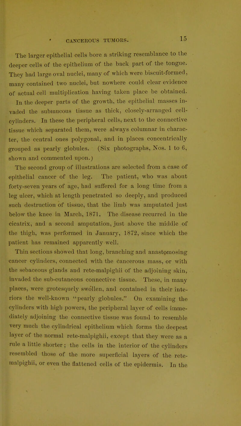 The larger epithelial cells bore a striking resemblance to the deeper cells of the epithelium of the back part of the tongue. They had large oval nuclei, many of which were biscuit-formed, many contained two nuclei, but nowhere could clear evidence of actual cell multiplication having taken place be obtained. In the deeper parts of the growth, the epithelial masses in- vaded the submucous tissue as thick, closely-arranged cell- cylinders. In these the peripheral cells, nest to the connective tissue which separated them, were always columnar in charac- ter, the central ones polygonal, and in places concentrically grouped as pearly globules. (Six photographs, Nos. 1 to 6, shown and commented upon.) The second group of illustrations are selected from a case of epithelial cancer of the leg. The patient, who was about forty-seven years of age, had suffered for a long time from a leg ulcer, which at length penetrated so deeply, and produced such destruction of tissue, that the limb was amputated just below the knee in March, 1871. The disease recurred in the cicatrix, and a second amputation, just above the middle of the thigh, was performed in January, 1872, since which the patient has remained apparently well. Thin sections showed that long, branching and anastomosing cancer cylinders, connected with the cancerous mass, or with the sebaceous glands and rete-malpighii of the adjoining skin, invaded the sub-cutaneous connective tissue. These, in many plaees, were grotesquely swollen, and contained in their inte- riors the well-known pearly globules. On examining the cylinders with high powers, the peripheral layer of cells imme- diately adjoining the connective tissue was found to resemble very much the cylindrical epithelium which forms the deepest layer of the normal rete-malpighii, except that they were as a rule a little shorter; the cells in the interior of the cylinders resembled those of the more superficial layers of the rete- malpighii, or even the flattened cells of the epidermis. In the