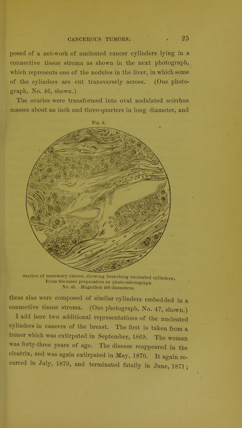 posed of a net-work of nucleated cancer cylinders lying in a connective tissue stroma as shown in the next photograph, which represents one of the nodules in the liver, in which some of the cj'linders are cut transversely across. (One photo- graph, No. 46, shown.) The ovaries were transformed into oval nodulated scirrhus masses about an inch and three-quarters in long diameter, and Fig. i. Section of mammary cancer, showing branching nucleated cylinders. From the same preparation as photo-micrograph No. 45. Magnified 400 diameters. these also were composed of similar cylinders embedded in a connective tissue stroma. (One photograph, No. 47, shown.) I add here two additional representations of the nucleated cylinders in cancers of the breast. The first is taken from a tumor which was extirpated in September, 1869. The woman was forty-three years of age. The disease reappeared in the cicatrix, and was again extirpated in May, 1870. It again re- curred in July, 1870, and terminated fatally in June, 1871 ;