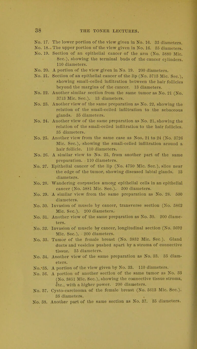 No. 17. The lower portion of the view given in No. 16. 35 diameters. No. 18.. The upper portion of the view given in No. 16. 35 diameters. No. 19. Section of an epithelial cancer of the arm (No. 5880 Mic. Sec), showing the terminal buds of the cancer cylinders. 110 diameters. No. 20. A portion of the view given in No. 19. 200 diameters. No. 21. Section of an epithelial cancer of the lip (No. 3713 Mic. Sec), showing small-celled infiltration between the hair follicles beyond the margins of the cancer. 13 diameters. No. 22. Another similar section from the same tumor as No. 21 (No. 3713 Mic. Sec). 13 diameters. No. 23. Another view of the same preparation as No. 22, showing the relation of the small-celled infiltration to the sebaceous glands. 35 diameters. No. 24. Another view of the same preparation as No. 21, showing the relation of the small-celled infiltration to the hair follicles. 35 diameters. No. 25. Another view from the same case as Nos. 21 to 24 (No. 3726 Mic. Sec.),-showing the small-celled infiltration around a hair follicle. 110 diameters. No. 26. A similar view to No. 25, from another part of the same preparation. • 110 diameters. No. 27. Epithelial cancer of the lip (No. 4750 Mic. Sec), slice near the edge of the tumor, showing diseased labial glands. 13 diameters. No. 28. Wandering corpuscles among epithelial cells in an epithelial cancer (No. 5881 Mic. Sec). 500 diameters. No. 29. A similar view from the same preparation as No. 28. 500 diameters. No. 30. Invasion of muscle by cancer, transverse section (No. 5862 Mic. Sec). 200 diameters.- No. 31. Another view of the same preparation as No. 30. 200 diame- ters. No. 32. Invasion of muscle by cancer, longitudinal section (No. 3692 Mic. Sec). 200 diameters. No. 33. Tumor of the female breast (No. 3852 Mic. Sec). Gland ducts and vesicles pushed apart by a stroma of connective tissue. 35 diameters. No. 34. Another view of the same preparation as No. 33. 35 diam- eters. No.-35. A portion of the view given by No. 33. 110 diameters. No. 36. A portion of another section of the same tumor as No. 33 (No. 8851 Mic Sec), showing the connective tissue stroma, etc, with a higher power. 200 diameters. No. 37. Cysto-carcinoma of the female breast (No. 5613 Mic. Sec). 35 diameters. No. 38. Another part of the same section as No. 37. 35 diameters.