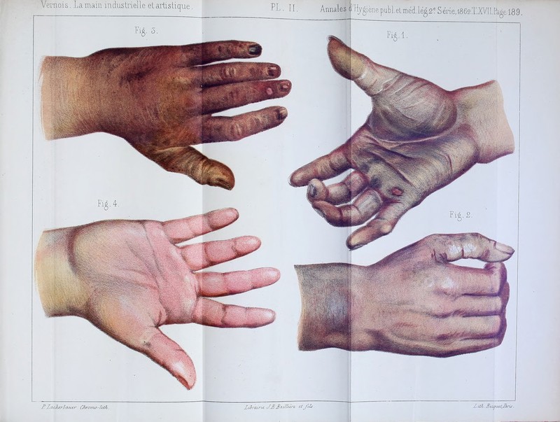 T. Xci.</cerda(ctr CÂrorno~U(/i^. Xiij'cuT'tc XXXcLiIlih'c C-t. X vô?L. Bu^uti-X^aris. Vernois, La main industrielle et artistique. ï’L .II, Annales |’Hj^ièn.epubl.etniéct.lé^.2 Série,l862.T,XV[l.Pa^fc 189. Fig. 2.