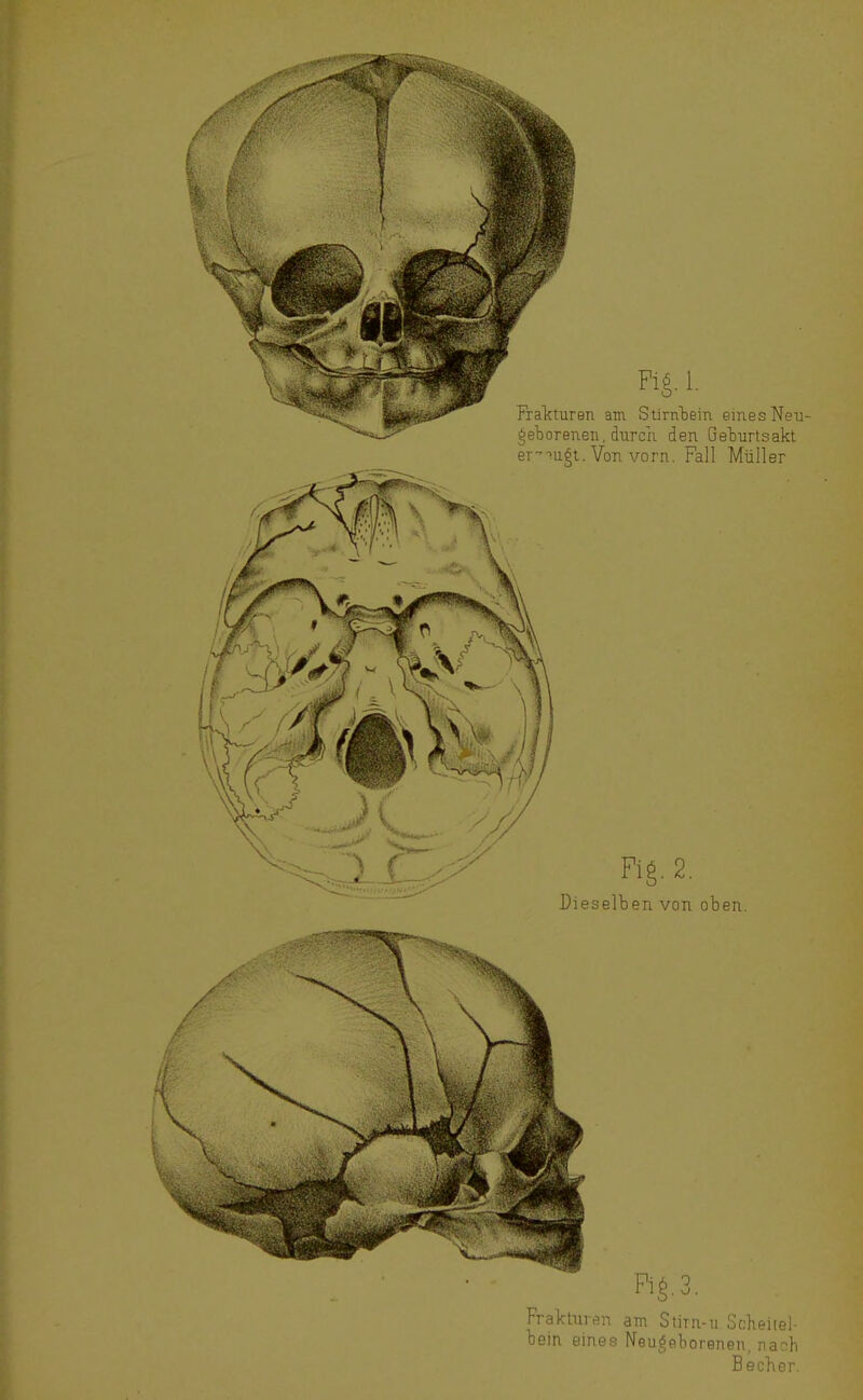 Dieselben von oben. Frakturen am StiTu-u Scheiie!- bein eines Neuöpborenen, nach Becher.