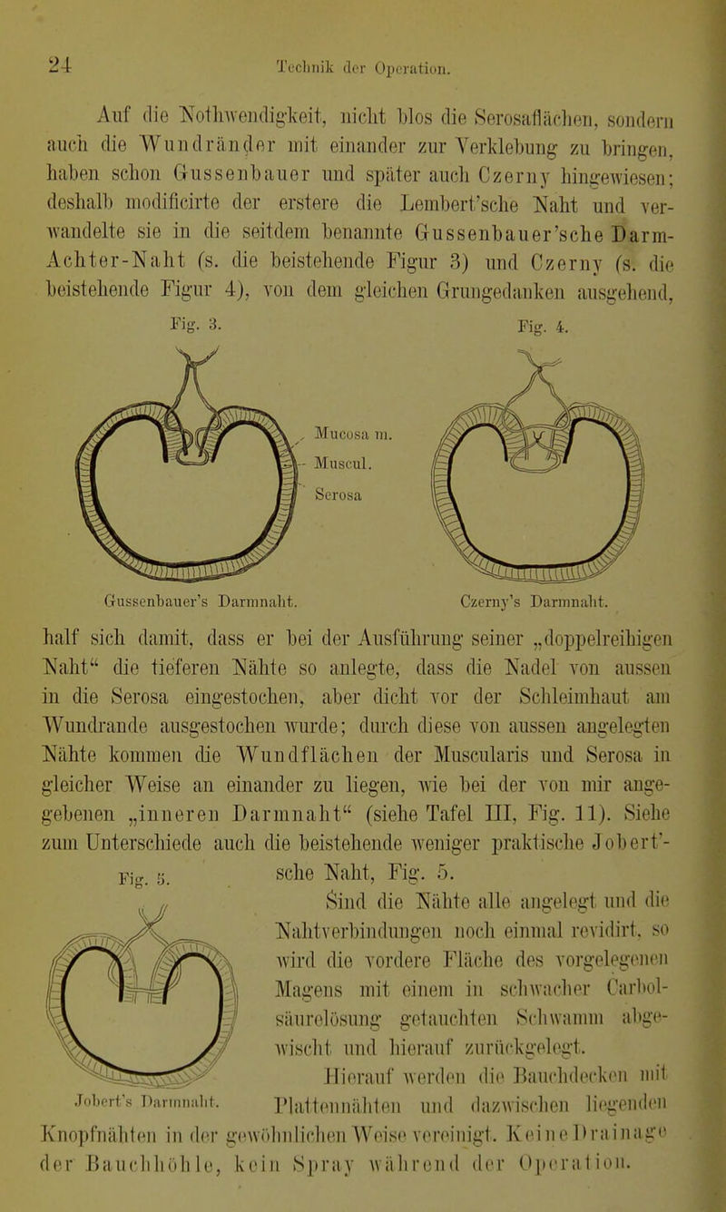 Auf die Notwendigkeit, nicht blos die Serosaflächen, sondern auch die Wundrän^er mit einander zur Yerklebung zu bringen, haben schon Grussenbauer und später auch Czerny hingewiesen; deshalb modificirte der erstere die Lembert'sche Naht und ver- wandelte sie in die seitdem benannte Gussenbauer'sche Darm- Achter-Naht (s. die beistehende Figur 3) und Czerny fs. die beistehende Figur 4). von dem gleichen Grungedanken ausgehend, Fig. 4. Fig. 3. Mucosa m. Muscul. Serosa Gussenbauer's Darm naht. Czerny's Darmnaht. half sich damit, dass er bei der Ausführung seiner „doppelreihigen Naht die tieferen Nähte so anlegte, dass die Nadel von aussen in die Serosa eingestochen, aber dicht vor der Schleimhaut am W undrande ausgestochen wurde; durch diese von aussen angelegter Nähte kommen die Wundflachen der Muscularis und Serosa in gleicher Weise an einander zu liegen, wie bei der von mir ange- gebenen „inneren Dannnaht (siehe Tafel III. Fig. 11). Siehe zum Unterschiede auch die beistehende weniger praktische Jobert'- sche Naht, Fig. 5. Sind die Nähte alle angelegt und die Nahtverbindungen noch einmal revidirt, so wird die vordere Fläche des vorgelegenen Magens mit einem in schwacher Carbol- säurelösung getauchten Schwamm abge- wischt und hierauf zurückgelegt. Hierauf werden die Bauchdecken inil riattenniihten und dazwischen liegenden Knopfnähten in der gewöhnlichen Weise vereinigt. Kein e Drainage der Bauchhöhle, kein Spray während der Operation. Fig. s. Jobert's Barninaht.