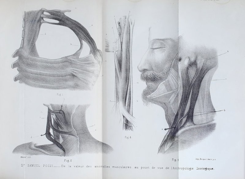 point de vue de l'AntAropologie écologique. lmp. Becquet Par/.? p.\ au Fig.l Fig. 4 Mesne] Lith D^' SAMUEL Fis. 2 POZZI De la valeur des anornalies musculaires