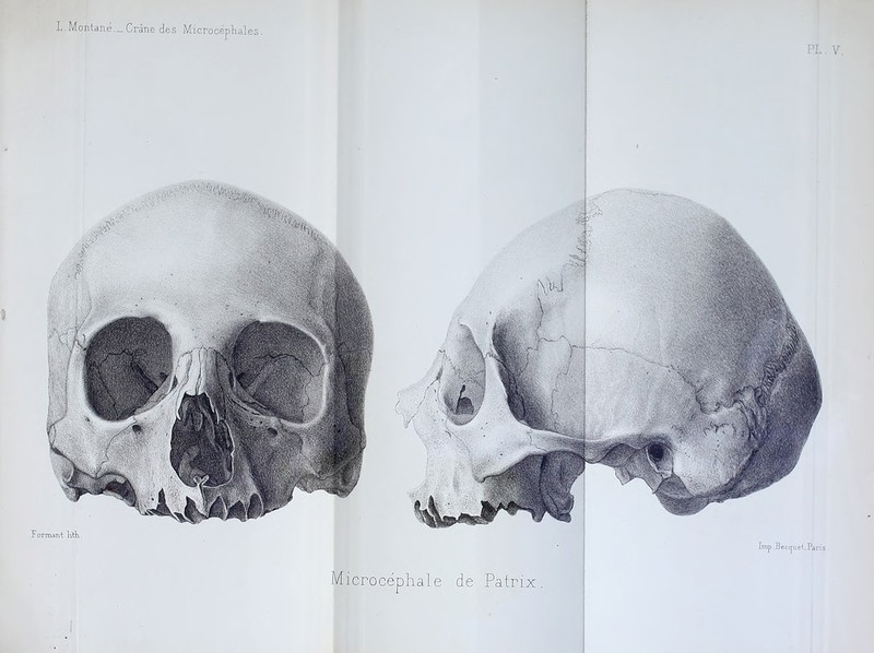 L.Montané._Crâne des Microcépliales.  ,!! r;,.V Tormant litK. frnp Bec^uef.Paris Microcéphale de Patrix.