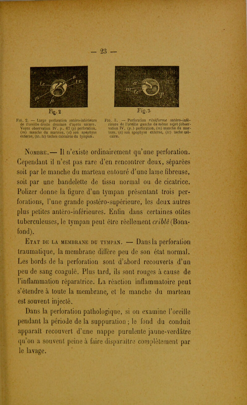 Fig.2 Fie. 2. — Large perforation antéro-inférieure de l'oreille droite dessinée d'après naiure. Voyez observation IV. p. 67 (p) perforation, (m) mancbe du marteau, (a) son apophyse externe, (te. te) taches calcaires du tympan. Fig.3 Fig. 3. — Perforalion réniforme antéro-infé- rieure de l'oreille gauche du même sujet (obser- vation IV. (p.) perforation, (m) manche du mar- teau, (a) son apophyse externe, {te) tache cal- caire. Nombre.— Il n'existe ordinairement qu'une perforation. Cependant il n'est pas rare d'en rencontrer deux, séparées soit par le manche du marteau entouré d'une lame fibreuse, soit par une bandelette de tissu normal ou de cicatrice. Polizer donne la figure d'un tympan présentant trois per- forations, Tune grande postéro-supérieure, les deux autres plus petites anléro-inférieures. Enfin dans certaines otites tuberculeuses, le tympan peut être réellement criblé (Bona- fond). Etat de la membrane du tympan. — Dans la perforation Iraumatique, la membrane diffère peu de son état normal. Les bords de la perforation sont d'abord recouverts d'un peu de sang coagulé. Plus tard, ils sont rouges à cause de l'inflammation réparatrice. La réaction inflammatoire peut s'étendre à toute la membrane, et le manche du marteau est souvent injecté. Dans la perforation pathologique, si on examine l'oreille pendant la période de la suppuration ; le fond du conduit apparaît recouvert d'une nappe purulente jaune-verdâtre qu'on a souvent peine à faire disparaître complètement par le lavage.