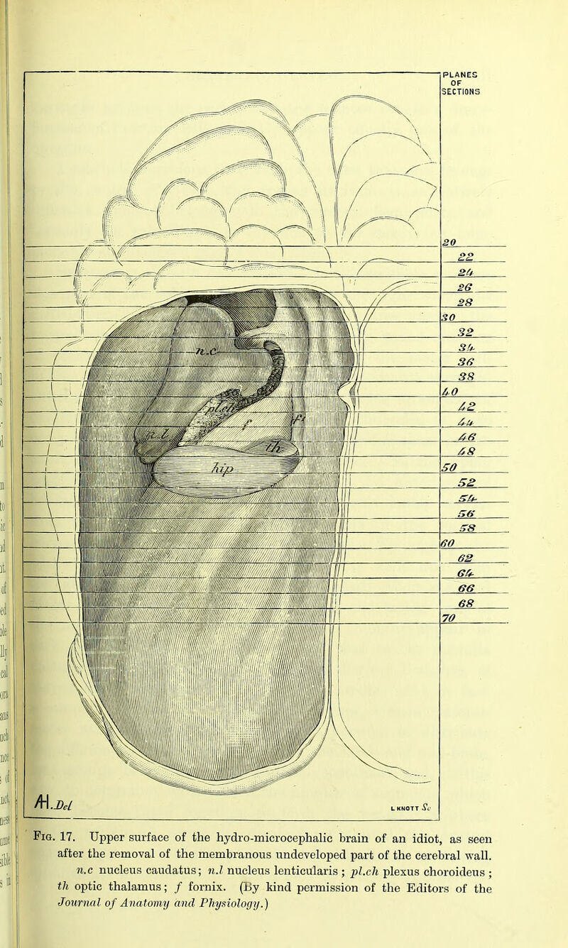 PLANES OF SECTIONS Pig. 17. Upper surface of the hydro-microcephalic brain of an idiot, as seen after the removal of the membranous undeveloped part of the cerebral wall. n.c nucleus caudatus; n.l nucleus lenticularis ; 2>l-ch plexus choroideus ; th optic thalamus; / fornix. (By kind permission of the Editors of the Journal of Anatomy and Pliysiologij.)