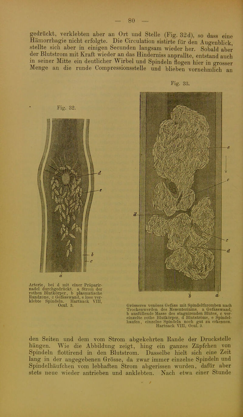 gedrückt, verklebten aber an Ort und Stelle (Fig. 32d), so dass eine Hämorrbagie nicbt erfolgte. Die Cireulation sistirte für den Augenblick stellte sich aber in einigen Secunden langsam wieder her. Sobald aber der Blutstrom mit Kraft wieder an das Hinderniss anprallte, entstand auch in seiner Mitte ein deutlicher Wirbel und Spindeln flogen hier in grosser Menge an die runde Compressionsstelle und blieben vornehmlich an Fig. 33. klebte Spindeln. Hartnack VIII, Ooul. 3. Grösseres venöses Gefäss mit Spindeltliromben nach Trockenwerden des Mesenteriums, a Gefässwand, b ausfüllende Masse des stagnirenden Blutes, c ver- einzelte rothe Blutköi-per, d Blutströme, e Spindel- haufen, einzelne Spindeln noch gut zu erkepnen. Hartnack VIII, Ocul. 3. den Seiten und dem vom Strom abgekehrten Rande der Druckstelle hängen. Wie die Abbildung zeigt, hing ein ganzes Zäpfchen von Spindeln flottirend in den Blutstrom. Dasselbe hielt sich eine Zeit lang in der angegebenen Grösse, da zwar immer einzelne Spindeln und Spindelhäufchen vom lebhaften Strom abgerissen wurden, dafür aber stets neue wieder antrieben und anklebten. Nach etwa einer Stunde