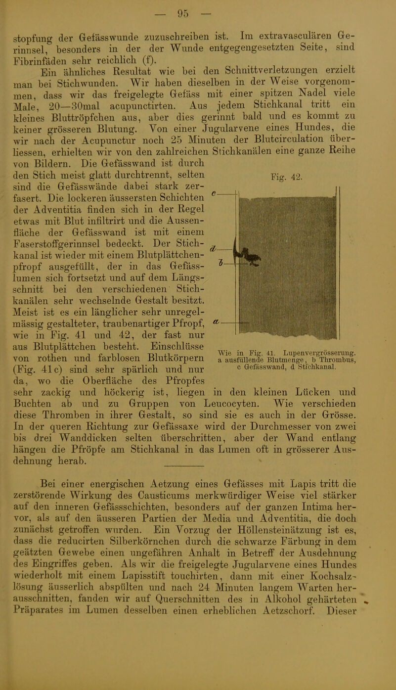 Fig. 42. |,||ll|iii;iiii|ii(ijiiiipiiiiiii[:i|[(i!liiii|iFi(iiii stopfung der Gefässwunde zuzuschreiben ist. Im exfcravasculären Ge- rinnsel, besonders in der der Wunde entgegengesetzten Seite, sind Fibrinfaden sehr reichlich (f). Ein ähnliches Resultat wie bei den Schnittverletzungen erzielt man bei Stichwunden. Wir haben dieselben in der Weise vorgenom- men, dass wir das freigelegte Gefäss mit einer spitzen Nadel viele Male, 20—30mal aciipunctirten. Aus jedem Stichkanal tritt ein kleines Bluttröpfchen aus, aber dies gerinnt bald und es kommt zu keiner grösseren Blutung. Von einer Jugularvene eines Hundes, die wir nach der Acupunctur noch 25 Minuten der Blutcirculation über- liessen, erhielten wir von den zahlreichen Stichkanälen eine ganze Reihe von Bildern. Die Gefäss wand ist durch den Stich meist glatt durch trennt, selten sind die Gefässwände dabei stark zer- fasert. Die lockeren äussersten Schichten der Adventitia finden sich in der Regel etwas mit Blut infiltrirt und die Aussen- fläche der Gefässwand ist mit einem Faserstoffgerinnsel bedeckt. Der Stich- kanal ist wieder mit einem Blutplättchen- pfropf ausgefüllt, der in das Gefäss- lumen sich fortsetzt und auf dem Längs- schnitt bei den verschiedenen Stich- kanälen sehr wechselnde Gestalt besitzt. Meist ist es ein länglicher sehr unregel- mässig gestalteter, traubenartiger Pfropf, ^ wie in Fig. 41 und 42, der fast nur aus Blutplättchen besteht. Einschlüsse von rothen und farblosen Blutkörpern (Fig. 41c) sind sehr spärlich und nur da, wo die Oberfläche des Pfropfes sehr zackig und höckerig ist, liegen in den kleinen Lücken und Buchten ab und zu Gruppen von Leucocyten. Wie verschieden diese Thromben in ihrer Gestalt, so sind sie es auch in der Grösse. In der queren Richtung zur Gefässaxe wird der Durchmesser von zwei bis drei Wanddicken selten überschritten, aber der Wand entlang hängen die Pfröpfe am Stichkanal in das Lumen oft in grösserer Aus- dehnung herab. illilllll|l;llBliill-lii'.Slil||||j| Wie in Fig. 41. Liipenvergrösserung. a ausfüllende Blutmenge, b Thrombus, c Gefässwand, d Stichkanal. Bei einer energischen Aetzung eines Gefässes mit Lapis tritt die zerstörende Wirkung des Causticums merkwürdiger Weise viel stärker auf den inneren Gefässschichten, besonders auf der ganzen Intima her- vor, als auf den äusseren Partien der Media und Adventitia, die doch zunächst getroffen wurden. Ein Vorzug der Höllensteinätzung ist es, dass die reducirten Silberkörnchen durch die schwarze Färbung in dem geätzten Gewebe einen ungefähren Anhalt in Betreff der Ausdehnung des Eingriffes geben. Als wir die freigelegte Jugularvene eines Hundes wiederholt mit einem Lapisstift touchirten, dann mit einer Kochsalz- lösung äusserhch abspülten und nach 24 Minuten langem Warten her- ausschnitten, fanden wir auf Querschnitten des in Alkohol gehärteten Präparates im Lumen desselben einen erheblichen Aetzschorf Dieser