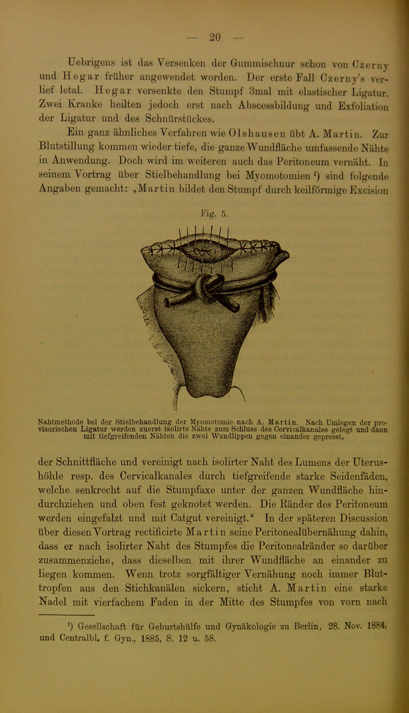üebrigeiis ist das Versenken der Gummischnur schon von Czern}- und Hegar früher angewendet worden. Der erste Fall Czerny's ver- lief letal. Hegar versenkte den Stumpf 3mal mit elastischer Ligatur. Zwei Kranke heilten jedoch erst nach Abscessbildung und Exfoliation der Ligatur und des Schnürstückes. Ein ganz ähnliches Verfahren wie Olshausen übt A. Martin. Zur Blutstillung kommen wieder tiefe, die ganze Wundfläche umfassende Nähte in Anwendung. Doch wird im weiteren auch das Peritoneum vernäht. In seinem Vortrag über Stielbehandlung bei Myomotomien ^) sind folgende Angaben gemacht: „Martin bildet den Stumpf durch keilförmige Excision Fig. 5. Nahtmethode bei der Stielbehandlung der Myomotomie nach A. Martin. Nach Umlegen der pro- visorischeu Ligatur werden zuerst isolirte Nähte zum Schluss des Cervicalkanales gelegt und dann mit tiefgreifenden Nähten die zwei Wundlippen gegen einander gepresst. der Schnittfläche und vereinigt nach isolirter Naht des Lumens der TJterus- höhle resp. des Cervicalkanales durch tiefgreifende starke Seidenfäden, welche senkrecht auf die Stumpfaxe unter der ganzen Wundfläche hin- durchziehen und oben fest geknotet werden. Die Ränder des Peritoneum werden eingefalzt und mit Catgut vereinigt. In der späteren Discussion über diesen Vortrag rectificirte Martin seine Peritonealübernähung dahin, dass er nach isolirter Naht des Stumpfes die Peritonealränder so darüber zusammenziehe, dass dieselben mit ihrer Wundfläche an einander zu liegen kommen. Wenn trotz sorgfältiger Vernähung noch immer Blut- tropfen aus den Stichkanälen sickern, sticht A. Martin eine starke Nadel mit vierfachem Faden in der Mitte des Stumpfes von vom nach 0 Gesellschaft für Geburtshülfe und Gynäkologie zu Berhn, 28. Nov. 1884, und CentralbU f. Gyn., 1885, S. 12 u. 58.
