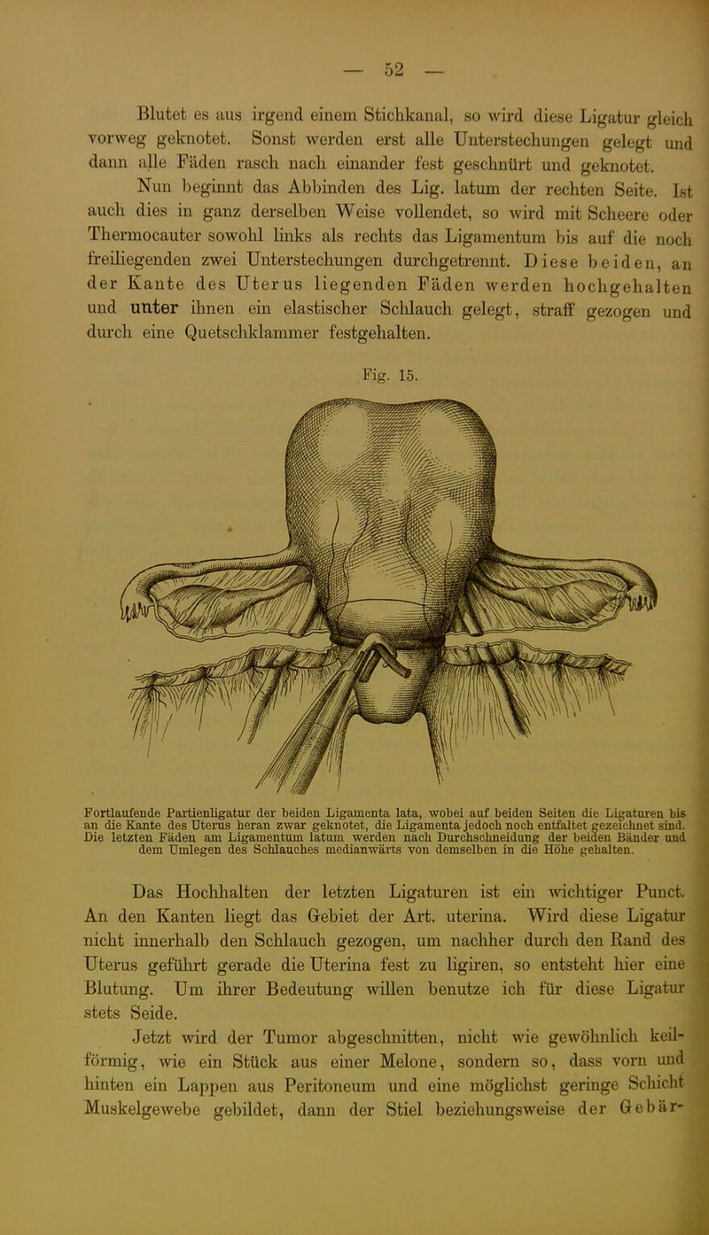 Blutet es aus irgend einem Stichkanal, so wird diese Ligatur gleich vorweg geknotet. Sonst werden erst alle Unterstechungen gelegt und dann alle Fäden rasch nach einander fest geschnürt und geknotet. Nun beginnt das Abbinden des Lig. latum der rechten Seite. Ist auch dies in ganz derselben Weise vollendet, so wird mit Scheere oder Thermocauter sowohl links als rechts das Ligamentum bis auf die noch freiliegenden zwei Unterstechungen durchgetrennt. Diese beiden, an der Kante des Uterus liegenden Fäden werden hochgehalten und unter ihnen ein elastischer Sclilauch gelegt, straff gezogen und dui'ch eine Quetschklammer festgehalten. Fig. 15. Fortlaufende Partienligatur der beiden Ligamenta lata, wobei auf beiden Seiten die Ligaturen bis an die Kante des Uterus heran zwar geknotet, die Ligamenta jedoch noch entfaltet gezeichnet sind. Die letzten Fäden am Ligamentum latum werden nach Durchschneidung der beiden Bänder und dem Umlegen des Schlauches medianwärts von demselben in die Höhe gehalten. Das Hochhalten der letzten Ligaturen ist ein wichtiger Punct. An den Kanten liegt das Gebiet der Art. uterina. Wird diese Ligatur nicht innerhalb den Schlauch gezogen, um nachher durch den Rand des Uterus geführt gerade die Uterina fest zu ligiren, so entsteht hier eine Blutung. Um ihrer Bedeutung willen benutze ich für diese Ligatur stets Seide. Jetzt wird der Tumor abgeschnitten, nicht wie gewöhnlich keil- förmig, wie ein Stück aus einer Melone, sondern so, dass vorn und hinten ein Lappen aus Peritoneum und eine möglichst geringe Schicht Muskelgewebe gebildet, dann der Stiel beziehungsweise der Gebär-