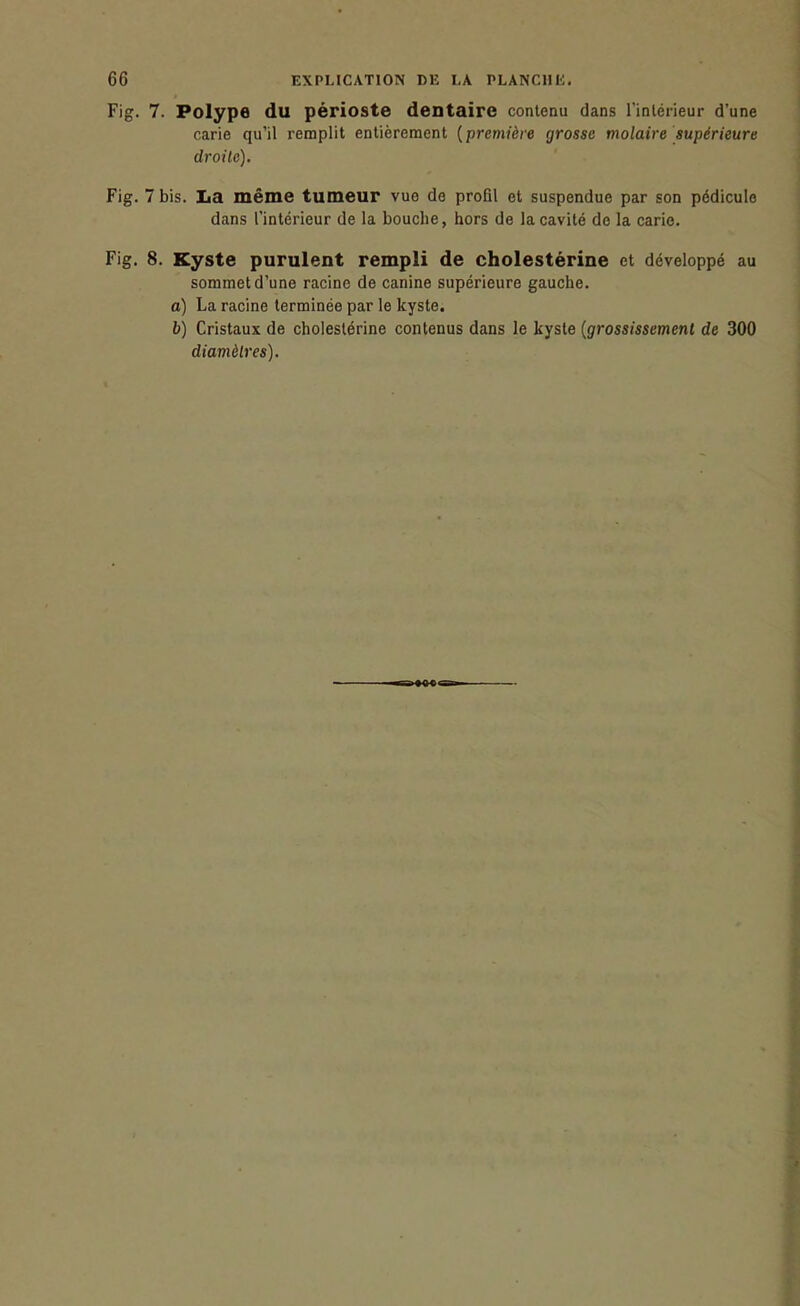 Fig. 7. Polype du périoste dentaire contenu dans l'intérieur d'une carie qu'il remplit entièrement [première grosse molaire supérieure droite). Fig. 7 bis. La même tumeur vue de profil et suspendue par son pédicule dans l'intérieur de la bouche, hors de la cavité de la carie. Fig. 8. Kyste purulent rempli de cholestérine et développé au sommet d'une racine de canine supérieure gauche. a) La racine terminée par le kyste. b) Cristaux de cholestérine contenus dans le kyste {grossissement de 300 diamètres).