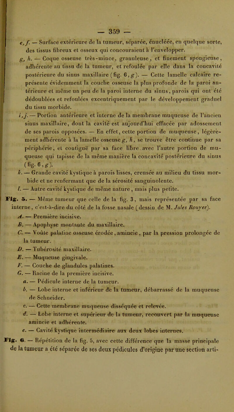 Cjf. — Surface extérieure de la tumeur, séparée, énucléée, en quelque sorte, des tissus fibreux et osseux qui concouraient à l'envelopper. g, h. — Coque osseuse très-mince, granuleuse, et finement spongieuse, adhérente au tissu de la tumeur, et refoulée par elle dans la concavité postérieure du sinus maxillaire (fig. 6,g). — Cette lamelle calcaire re- présente évidemment la couche osseuse la plus profonde de la paroi an- térieure et même un peu de la paroi interne du sinus, parois qui ont été dédoublées et refoulées excentriquement par le développement graduel du tissu morbide. ijj. — Portion antérieure et interne de la membrane muqueuse de l'ancien sinus maxillaire, dont la cavité est aujourd'hui effacée par adossement de ses parois opposées. — En effet, cette portion de muqueuse, légère- ment adhérente à la lamelle osseuse^ h, se trouve être continue par sa périphérie, et contiguë par sa face libre avec l'autre portion de mu- queuse qui tapisse de la même manière la concavité postérieure du sinus (%6,ér). fr. — Grande cavité kystique à parois lisses, creusée au milieu du tissu mor- bide et ne renfermant que de la sérosité sanguinolente. /. — Autre cavité kystique de même nature, mais plus petite. Fig. 5. — Même tumeur que celle de la fig. 3, mais représentée par sa face interne, c'est-à-dire du côté de la fosse nasale (dessin de M. Jules Rouyer). A. — Première incisive. B. —Apophyse montante du maxillaire. C. — Voûte palatine osseuse érodée, amincie, par la pression prolongée de la tumeur. D. —Tubérosité maxillaire. E. — Muqueuse gingivale. F. — Couche de glandules palatines. G. — Racine de la première incisive. a. — Pédicule interne de la tumeur. b. — Lobe interne et inférieur de la tumeur, débarrassé de la muqueuse de Schneider. c. — Cette membrane muqueuse disséquée et relevée. d. — Lobe interne et supérieur de la tumeur, recouvert par la muqueuse amincie et adhérente. e. — Cavité kystique intermédiaire aux deux lobes internes. Fig. ©. — Répétition de la fig. 5, avec cette différence que la masse principale de la tumeur a été séparée de ses deux pédicules d'origine par une section arti-