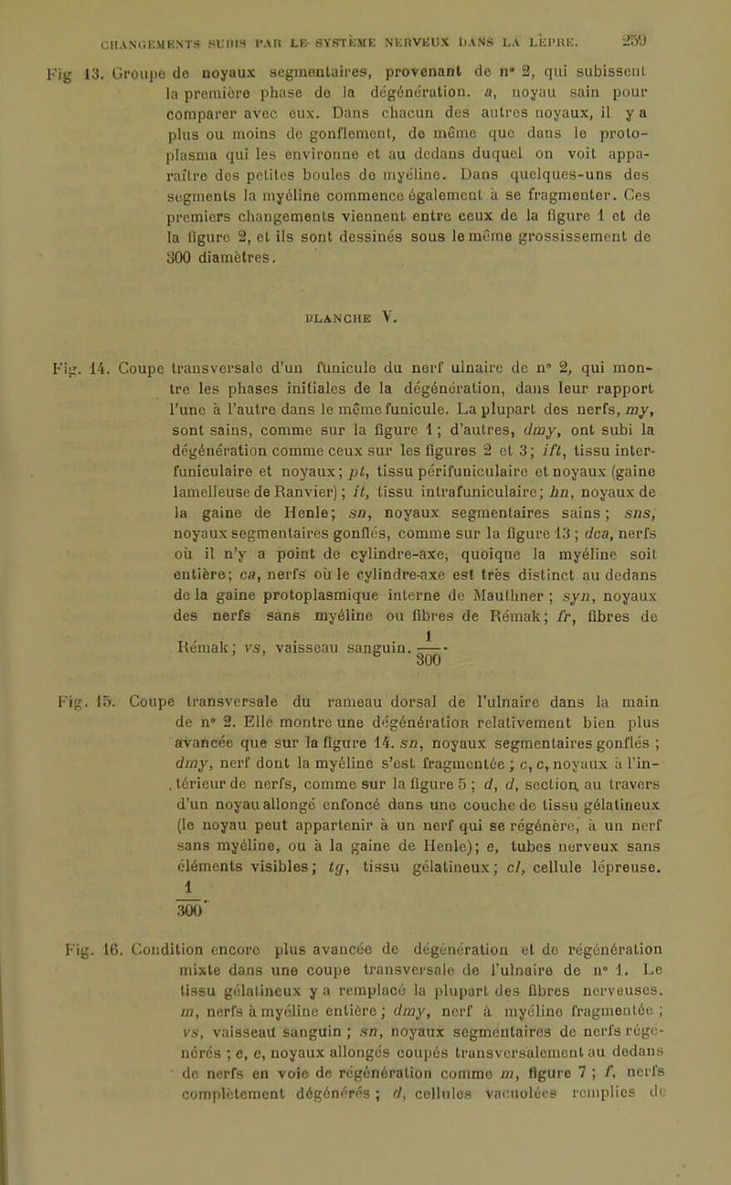 CHANOli.MENTS Hb'BIS l'Ail LB SYSTÈME NERVEUX DANS LA LÉl-HK. '2Ô'à 13. Groupe de noyaux seginenlaires, provenant de n* 2, qui subissent la première phase de la dégénération, a, noyau sain pour comparer avec eux. Dans chacun des autres noyaux, il y a plus ou moins do gonflement, de même que dans le prolo- plusma qui les environne et au dedans duquel on voit appa- raître des petites boules de myéline. Dans quelques-uns des segments la myéline commence également à se fragmenter. Ces premiers changements viennent entre ceux de la figure 1 et de la ligure 2, et ils sont dessinés sous le même grossissement de 300 diamètres. DLANCUE V. 14. Coupe transversale d'un funicule du nerf ulnaire de n° 2, qui mon- tre les phases initiales de la dégénoralion, dans leur rapport l'une à l'autre dans le même funicule. La plupart des nerfs, my, sont sains, comme sur la figure 1 ; d'autres, diny, ont subi la dégénération comme ceux sur les figures 2 et 3; ift, tissu inter- funiculaire et noyaux; pt, tissu périfuniculaire et noyaux (gaine lamolleuse de Ranvier) ; il, tissu intrafuniculairc; i/j, noyaux de la gaine de Henle; sn, noyaux segmenlaires sains; sns, noyaux segmentaires gonflés, comme sur la figure 13 ; dca, nerfs oii il n'y a point de cylindre-axe, quoique la myéline soit entière; ca, nerfs où le cylindre-axe est très distinct au dedans delà gaine protoplasmique interne de Mauthner ; syn, noyaux des nerfs sans myéline ou fibres de Rémak; fr, fibres de Rémak: vs, vaisseau sanguin.-^- * 300 . 15. Coupe transversale du rameau dorsal de l'ulnaire dans la main de n» 2. Elle montre une dégénéralioR relativement bien plus avancée que sur la figure l'i. sn, noyaux segmentaires gonflés ; dmy, nerf dont la myéline s'est fragmentée ; c, c, noyaux ii l'in- . lérieup de nerfs, comme sur la figure 5 ; d, d, sectiop, au travers d'un noyau allongé enfoncé dans une couche de tissu gélatineux (le noyau peut appartenir à un nerf qui se régénère, à un nerf sans myéline, ou à la gaine de Henle); e, tubes nerveux sans cléments visibles ; tg, tissu gélatineux ; cl, cellule lépreuse. J_ 300' g. 16. Condition encore plus avancée de dégénération et de régénération mixte dans une coupe transversale de l'ulnaire de n° 1. Le tissu gélatineux y a remplacé la plupart des fibres nerveuses, m, nerfs à myéline entière; dmy, nerf à myéline fragmentée; vs, vaisseau sanguin ; sn, noyaux segmentaires de nerfs régé- nérés ; e, c, noyaux allongés coupés transversalement au dedans • de nerfs en voie de régénération comme m, figure 7 ; /, nerfs complètement dégénérés ; d, cellules vaiMioléos remplies dt