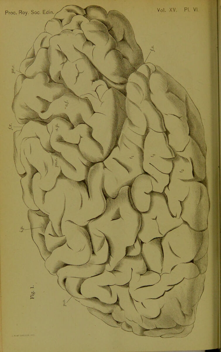 Plate from an 1888 study of a brain born without a corpus callosum