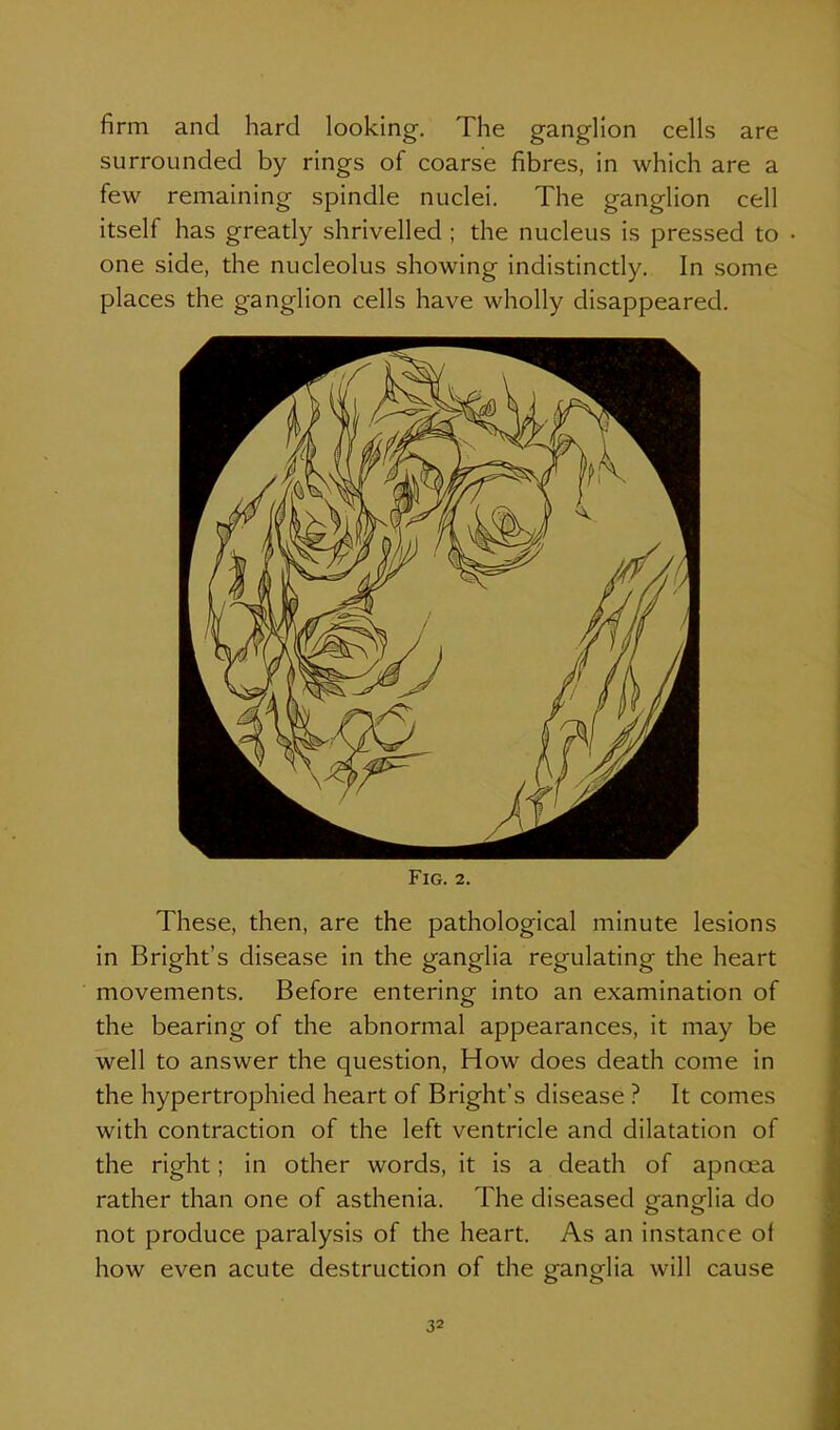 firm and hard looking. The ganglion cells are surrounded by rings of coarse fibres, in which are a few remaining spindle nuclei. The ganglion cell itself has greatly shrivelled ; the nucleus is pressed to one side, the nucleolus showing indistinctly. In some places the ganglion cells have wholly disappeared. Fig. 2. These, then, are the pathological minute lesions in Bright's disease in the ganglia regulating the heart movements. Before entering into an examination of the bearing of the abnormal appearances, it may be well to answer the question. How does death come in the hypertrophied heart of Bright's disease ? It comes with contraction of the left ventricle and dilatation of the right; in other words, it is a death of apnoea rather than one of asthenia. The diseased orano-lia do not produce paralysis of the heart. As an instance of how even acute destruction of the ganglia will cause