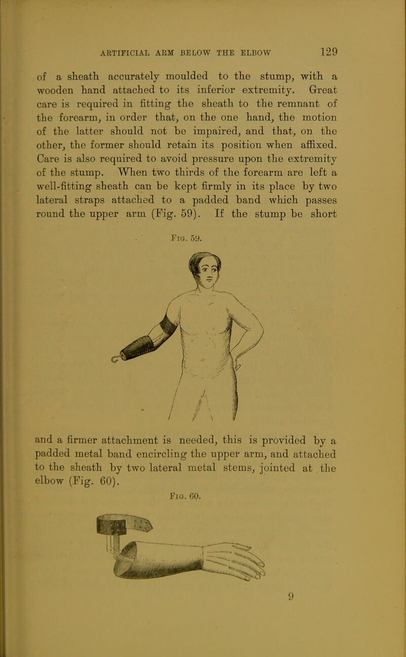of a sheatli accurately moulded to tlie stump, with, a wooden hand attached to its inferior extremity. Great care is required in fitting the sheath to the remnant of the forearm, in order that, on the one hand, the motion of the latter should not be impaired, and that, on the other, the former should retain its position when affixed. Care is also required to avoid pressure upon the extremity of the stump. When two thirds of the forearm are left a well-fitting sheath can be kept firmly in its place by two lateral straps attached to a padded band which passes round the upper arm (Fig. 69). If the stump be short Fig. 59. padded metal band encircling the upper arm, and attached to the sheath by two lateral metal stems, jointed at the elbow (Fig. 60). Fig. 60. 9