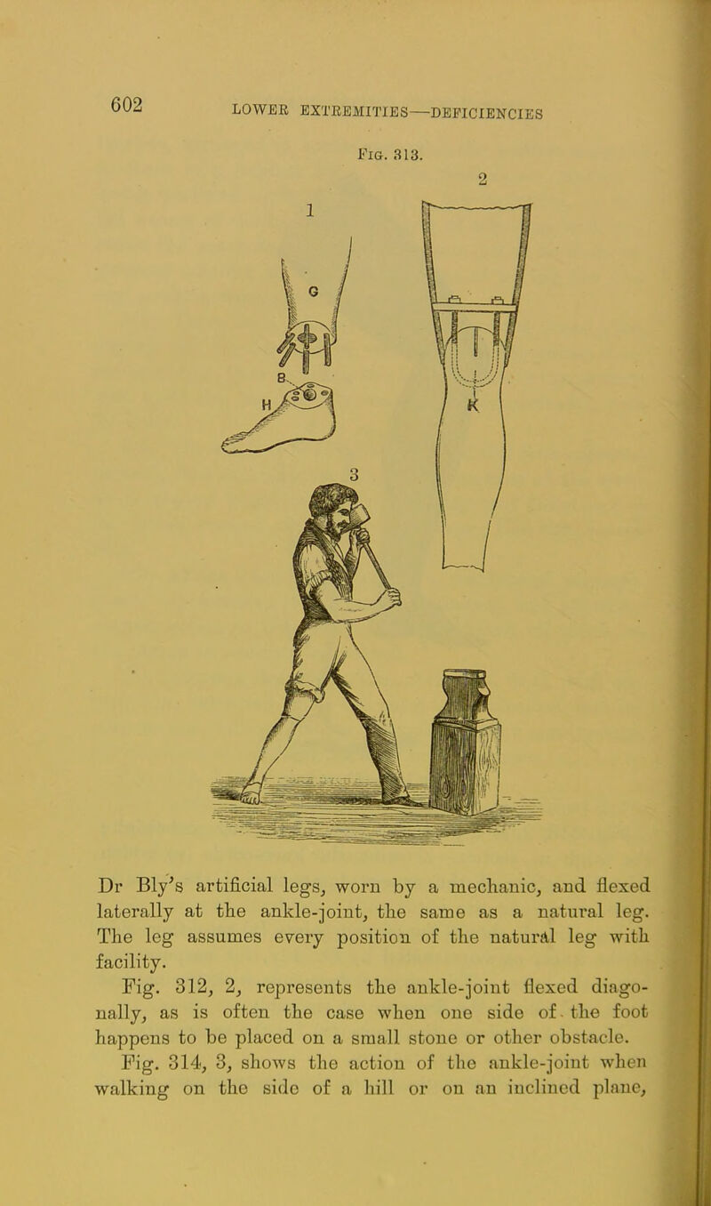 Fig. 313. Dr Bly's artificial legs, worn by a mechanic, and flexed laterally at tlie ankle-joint, the same as a natural leg. The leg assumes every position of the natural leg with facility. Fig. 312, 2, represents the ankle-joint flexed diago- nally, as is often the case when one side of. the foot happens to be placed on a small stone or other obstacle. Fig. 314, 3, shows the action of the ankle-joint when walking on the side of a hill or on an inclined plane,