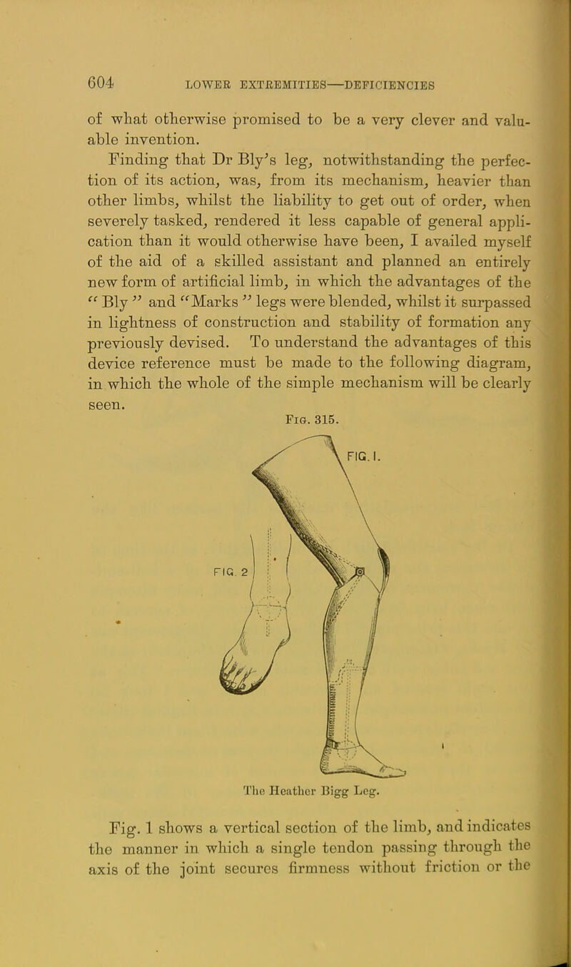 of what otherwise promised to be a very clever and valu- able invention. rinding that Dr Bly^s leg^ notwithstanding the perfec- tion of its action, was, from its mechanism, heavier than other limbs, whilst the liability to get out of order, when severely tasked, rendered it less capable of general appli- cation than it would otherwise have been, I availed myself of the aid of a skilled assistant and planned an entirely new form of artificial limb, in which the advantages of the Bly  and ^^Marks legs were blended, whilst it surpassed in lightness of construction and stability of formation any previously devised. To understand the advantages of this device reference must be made to the following diagram, in whichi the whole of the simple mechanism will be clearly seen. Fig. 315. The Heather Bigg Leg. Fig. 1 shows a vertical section of the limb, and indicates the manner in which a single tendon passing through the axis of the joint secures firmness without friction or the